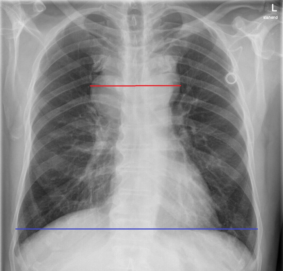 Großer Mediastinaltumor beim Hodgkin Lymphom