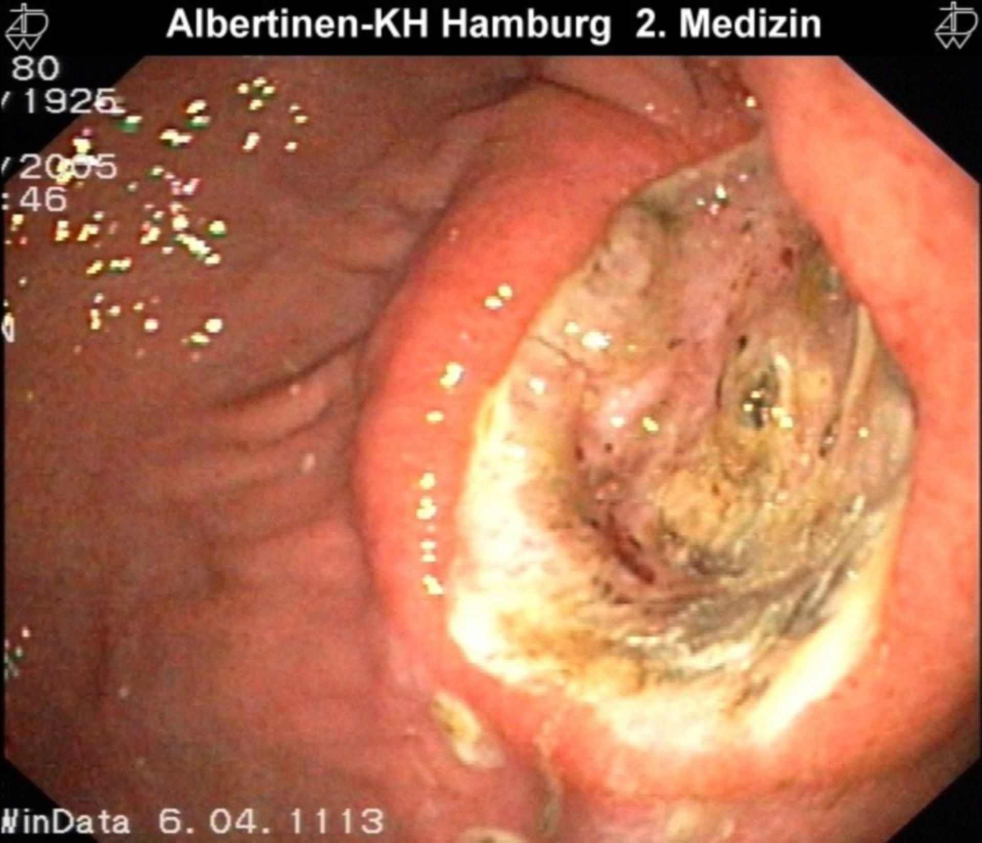 Ulcera corpo dello stomaco