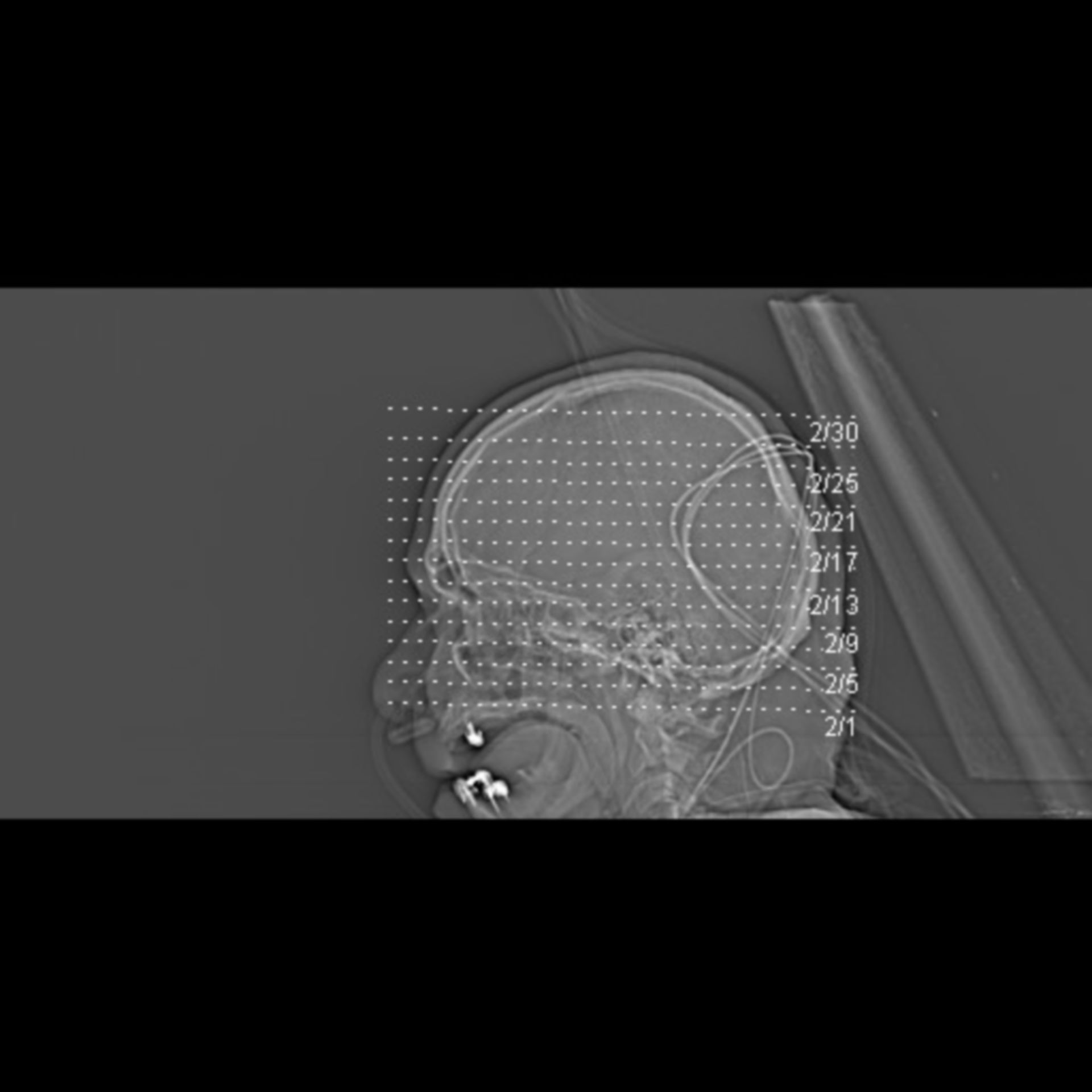 Gehirnblutung+Pneumonie 2