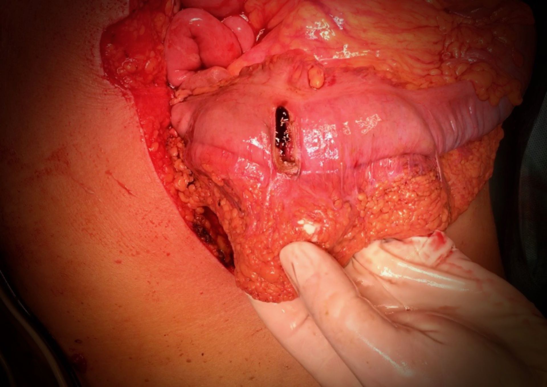 Querkolonperforation