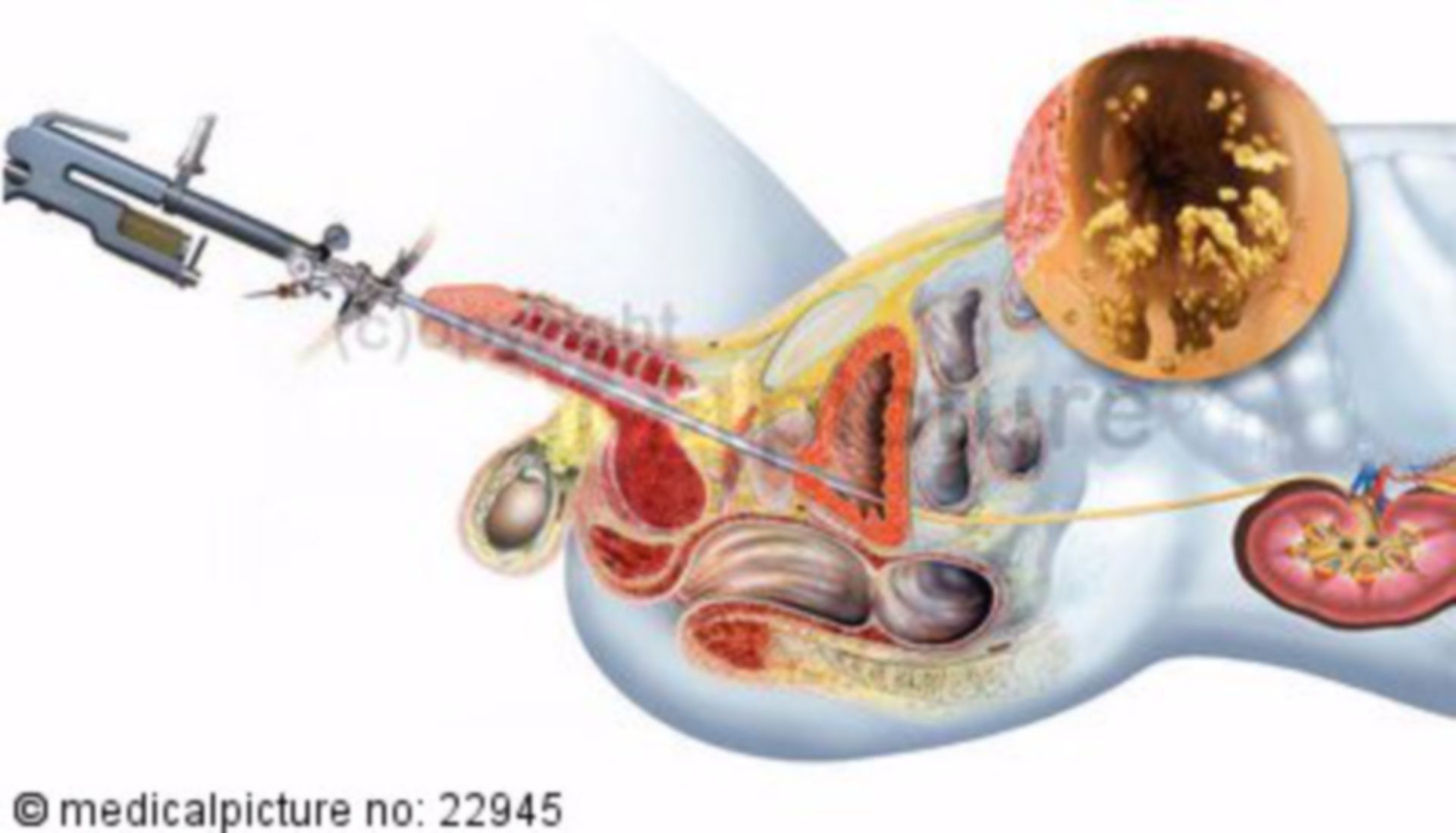 Ureteroskopische Entfernung von Harnleitersteinen, männlicher Unterkörper