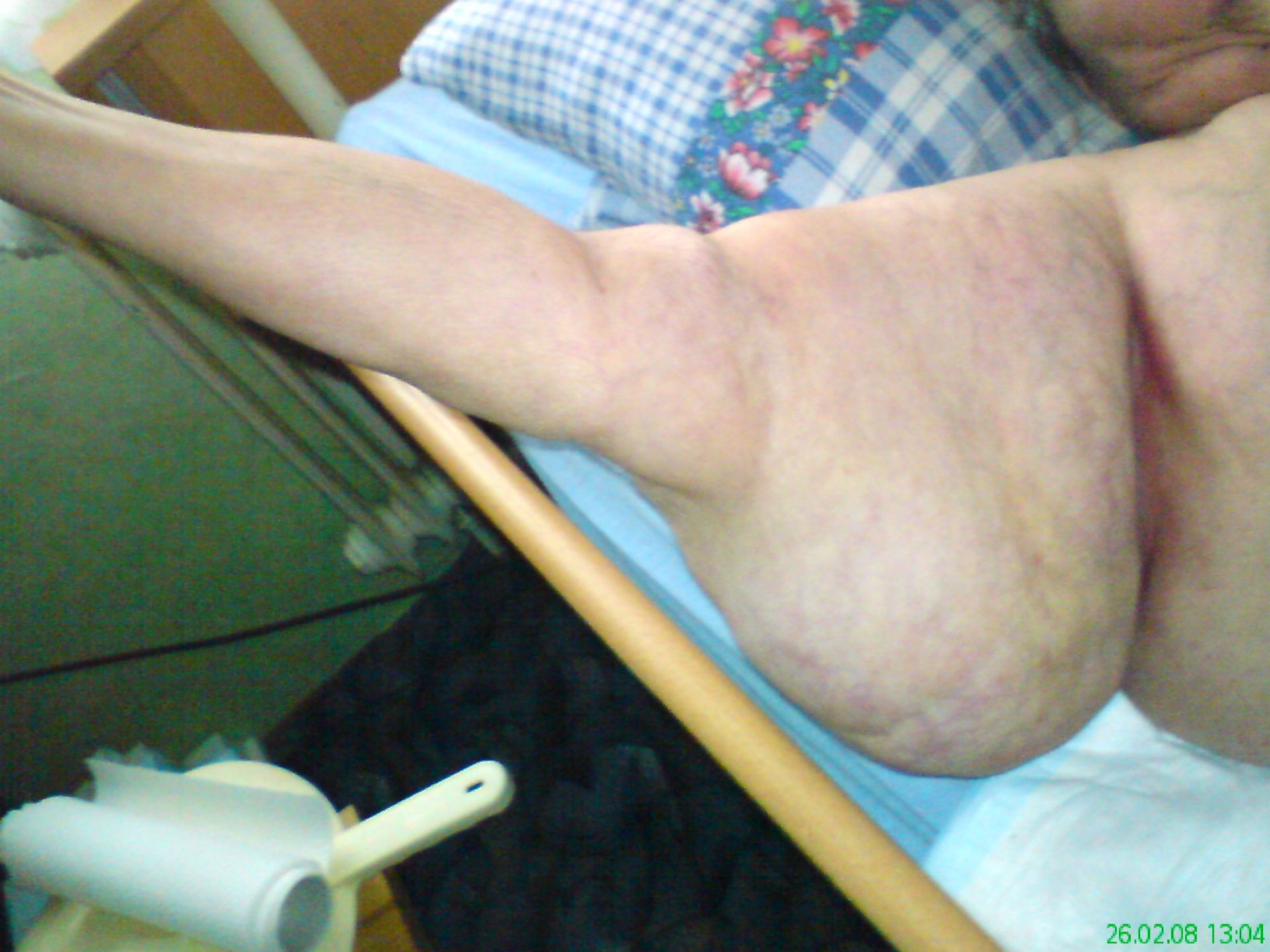 Lipoedema