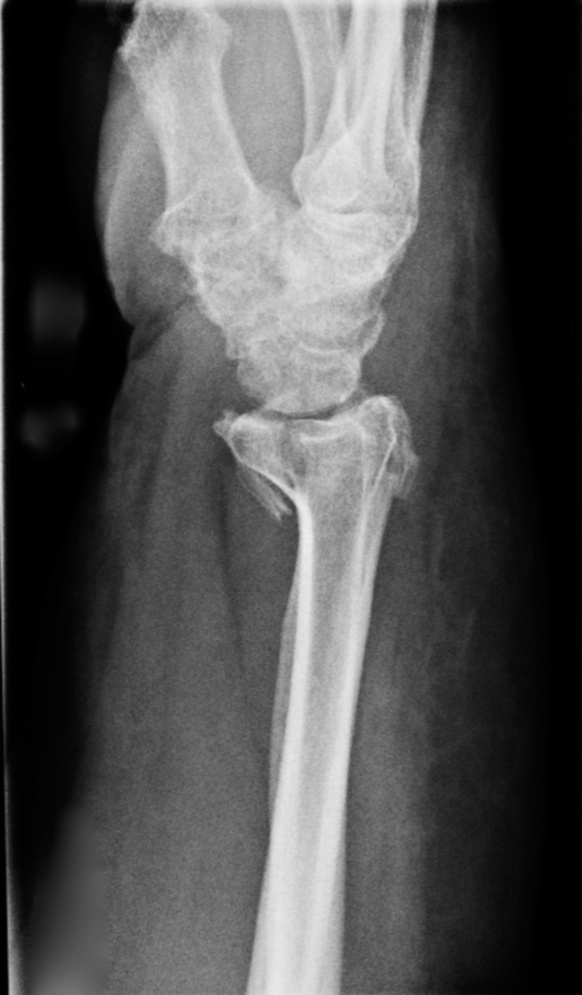 Röntgen des Handgelenkes mit distaler Radiusfraktur und resultierender Nervenkompression