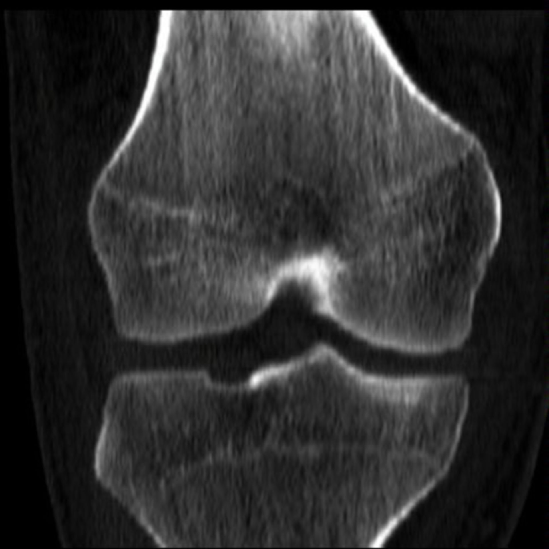 MRI of the knee joint
