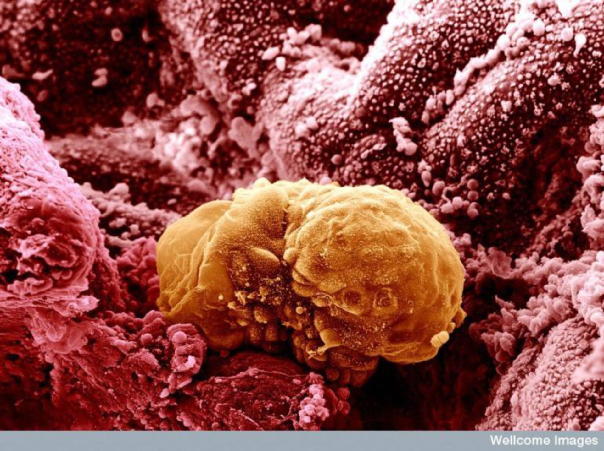 Rasterelektronenmikroskopische Aufnahme eines 6-tägigen menschlichen Embryos welches gerade beginnt die Linie des Uterus zu implantieren (Gebärmutterschleimhaut)