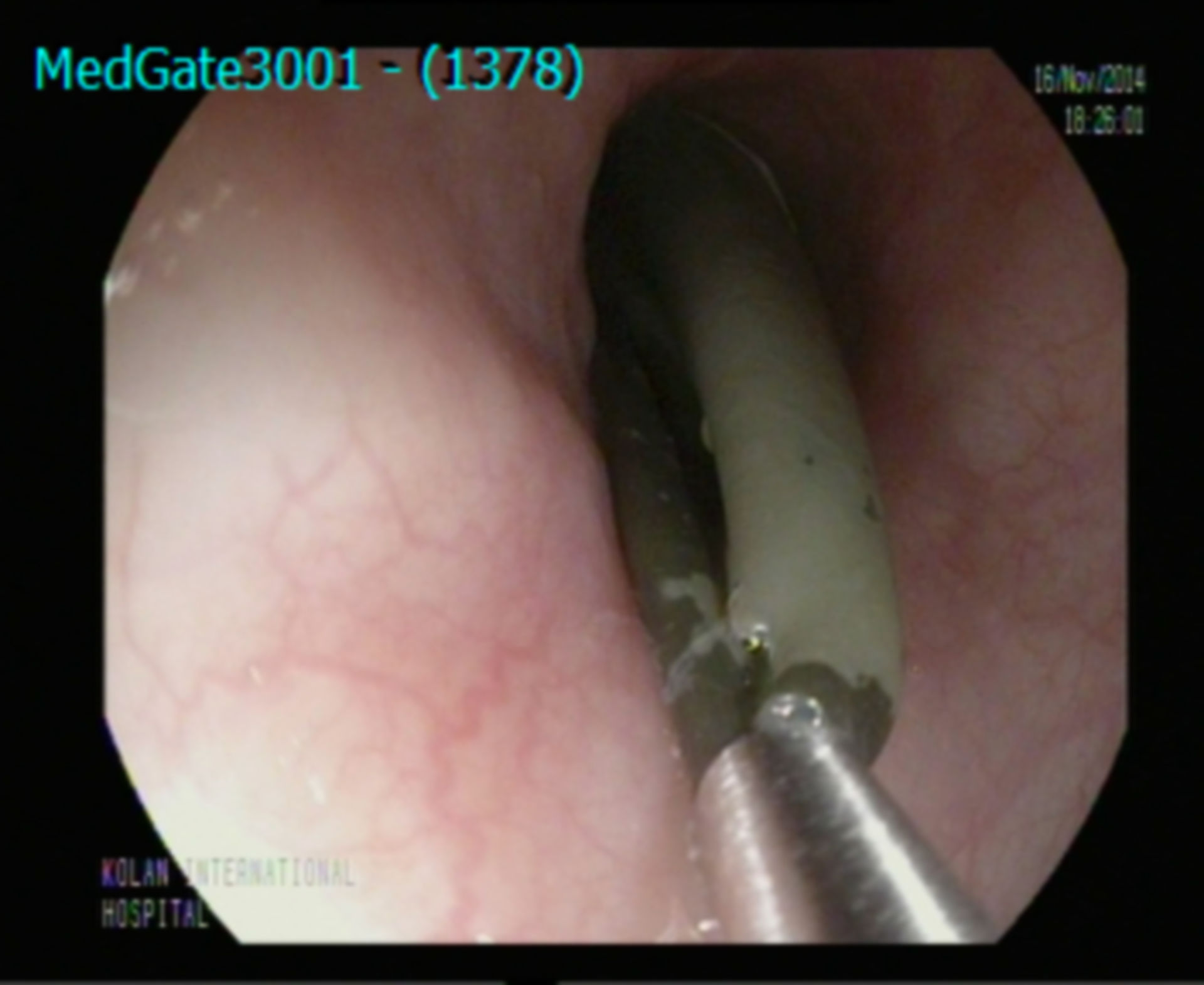 Removal of an intragastric silicone balloon, which is inserted 6 months ago for the treatment of obesity.