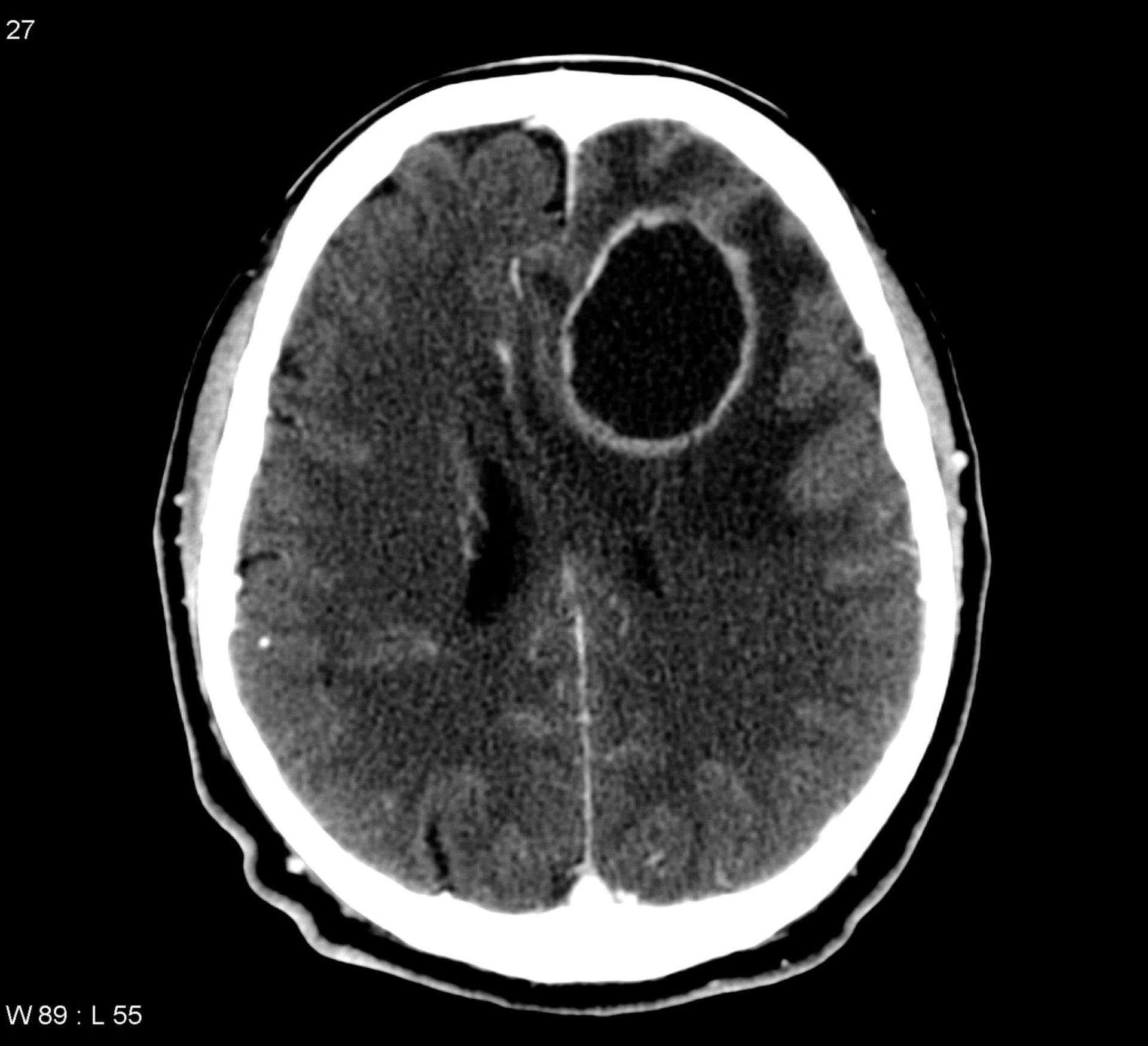 Absceso cerebral