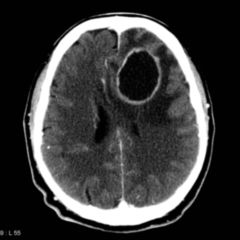 Cerebral blood volume - DocCheck Flexikon