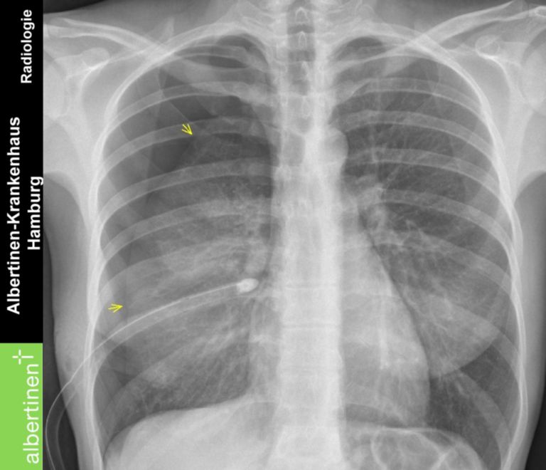 Pneumothorax P A - DocCheck