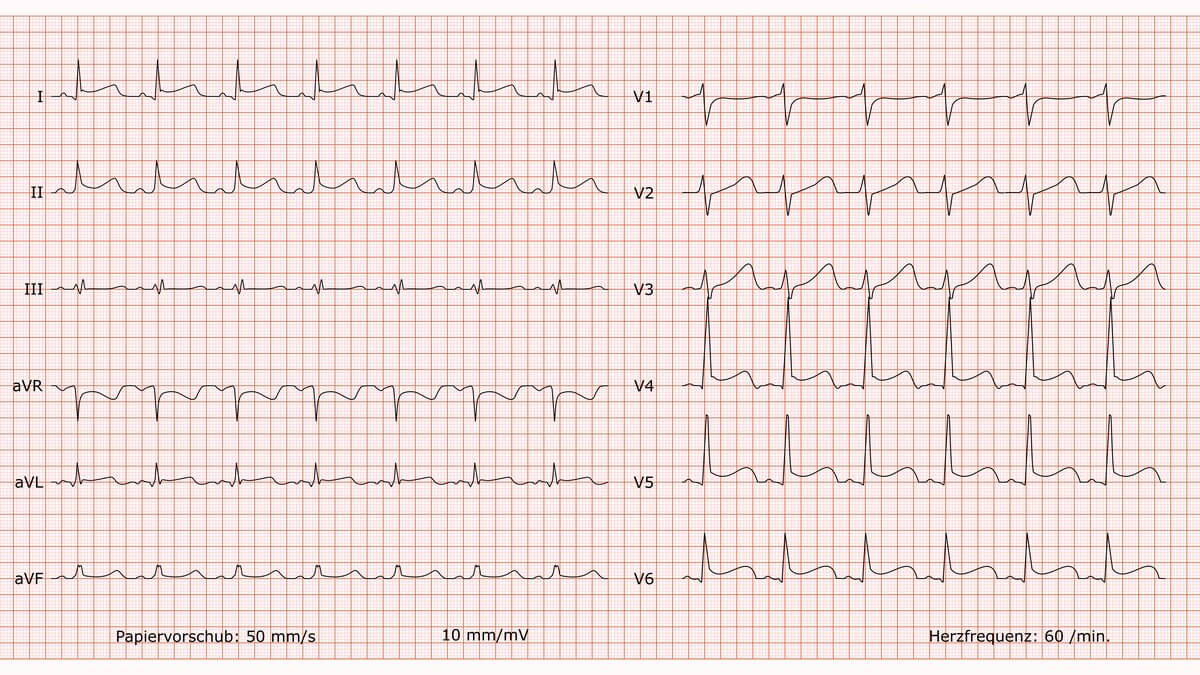 12-Kanal-EKG bei Perikarditis / Perimyokarditis