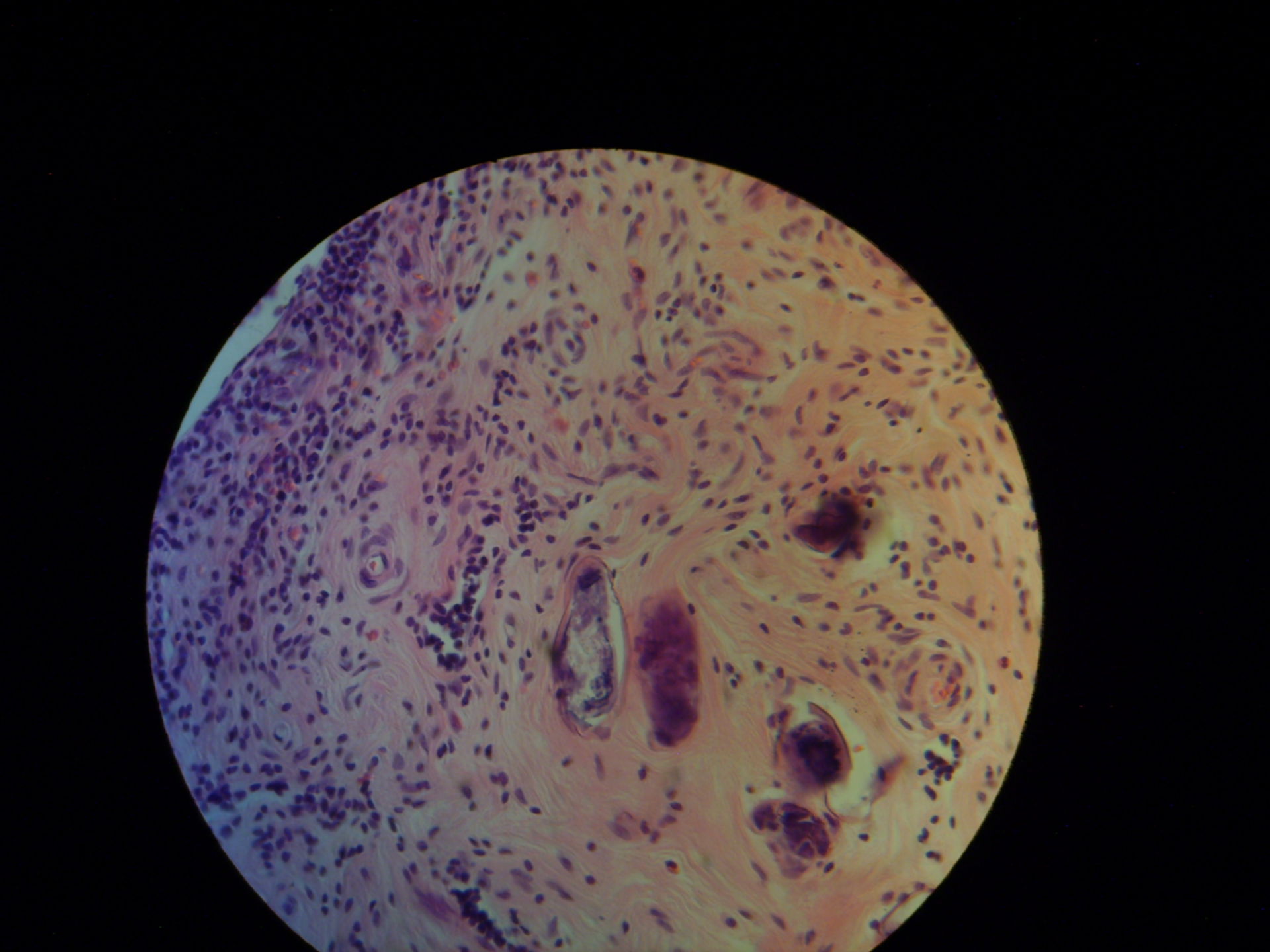 Schistosomiasis in Apendix vermiformis