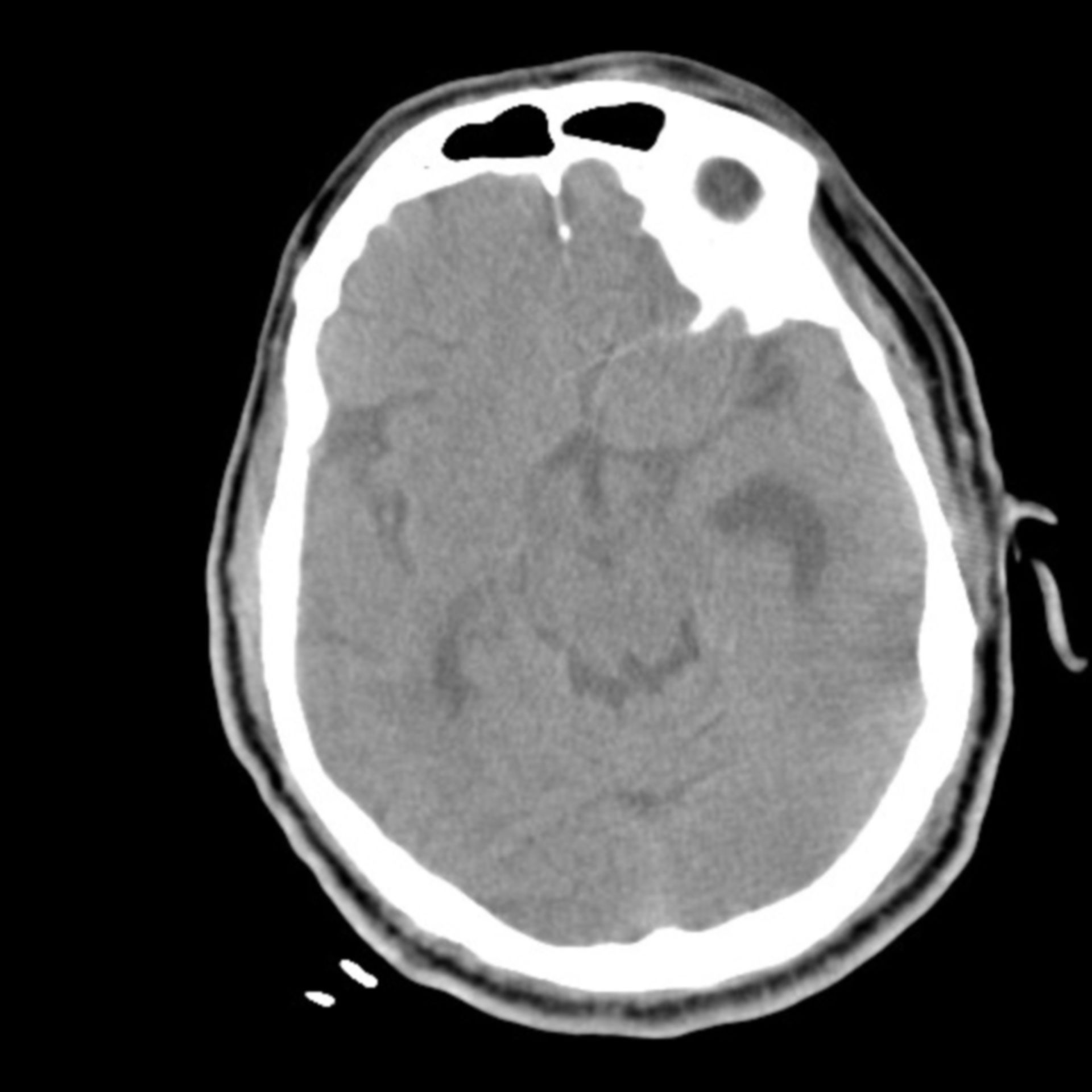 Gehirnblutung+Pneumonie 16