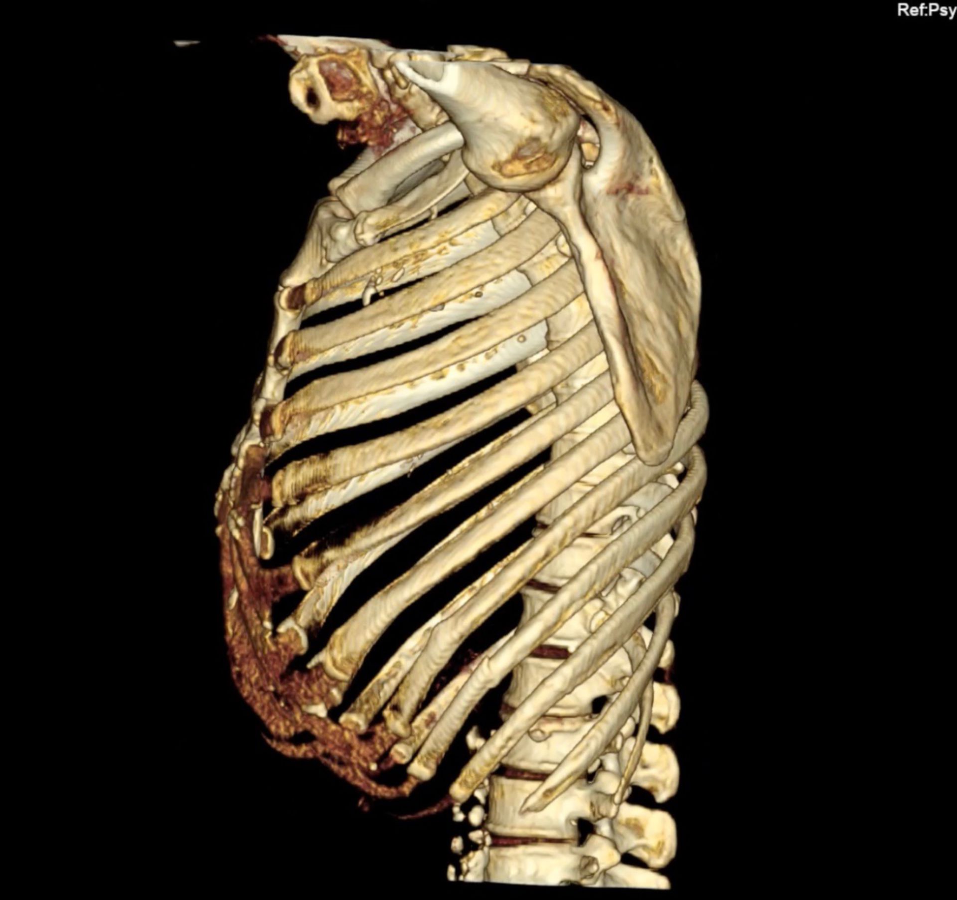 3D-Rekonstruktion einer CT des Thorax mit Ansicht von lateral mit Rippenfraktur