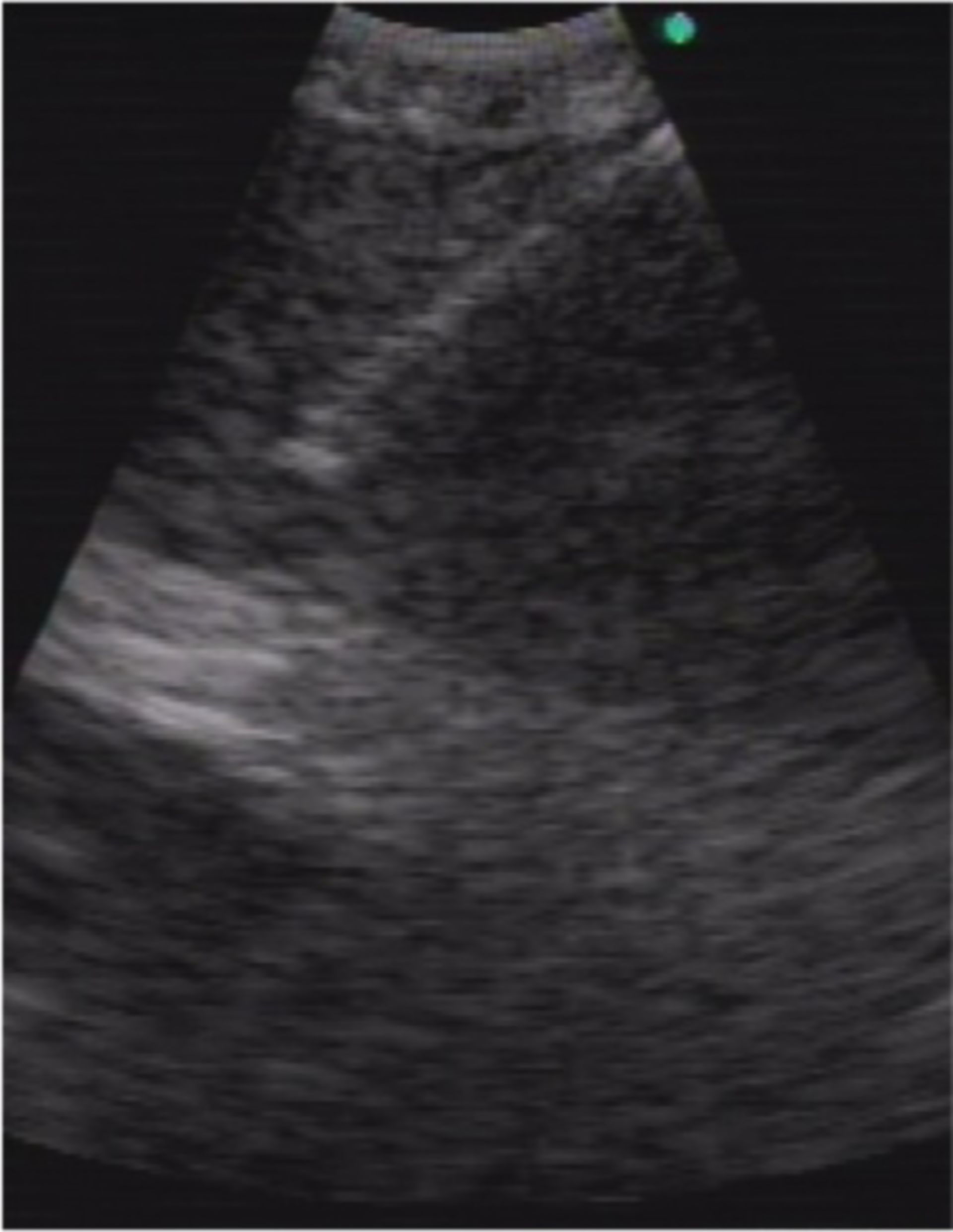 Endobronchialer Ultraschall (EBUS)