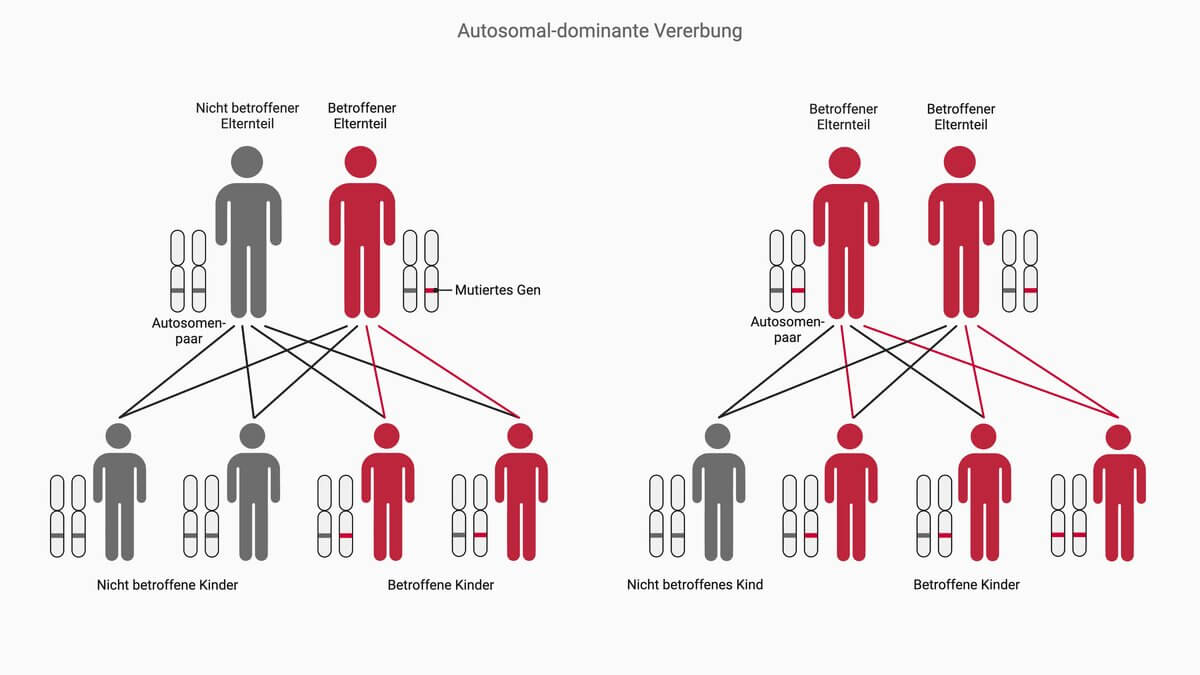 Autosomal-dominanter Erbgang