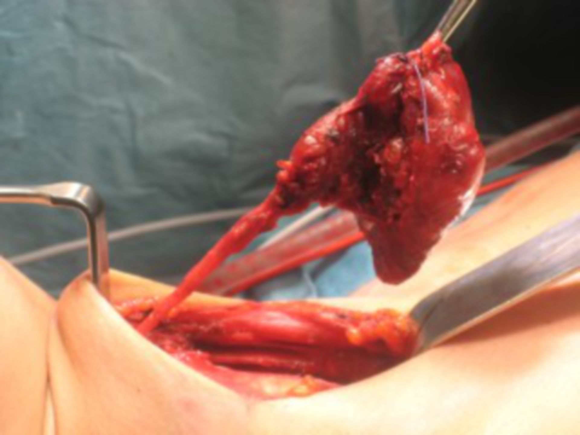 Chirurgia della tiroide