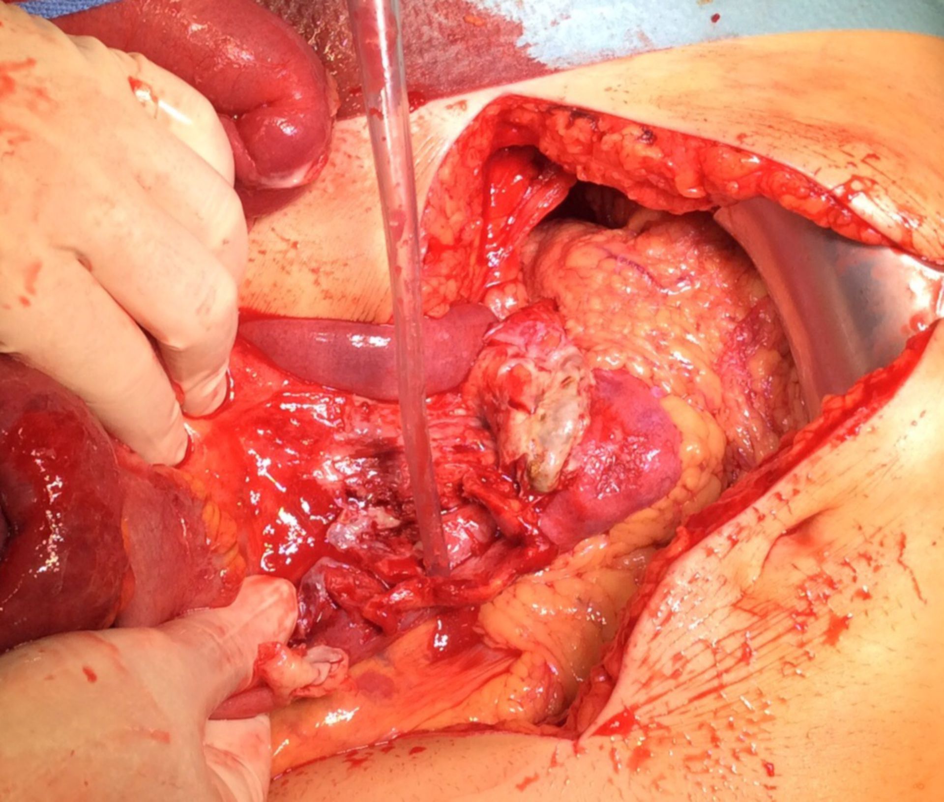 Perforated appendicitis with abscess