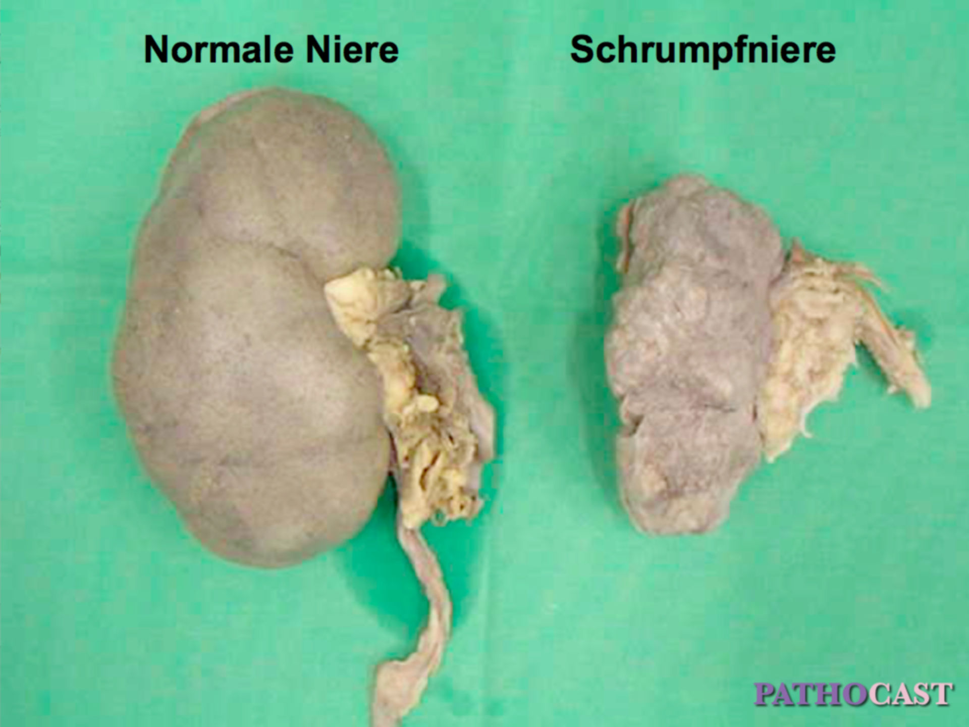 Shrunken kidney
