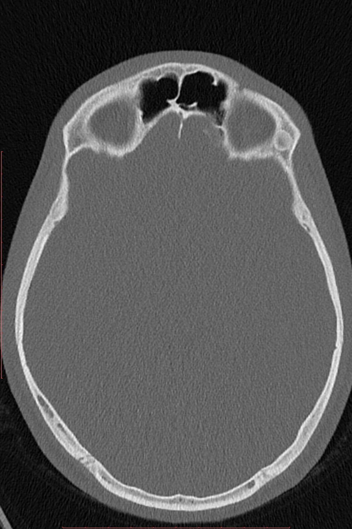 Osteom des Os zygomaticum (NNH-CT, Axial)