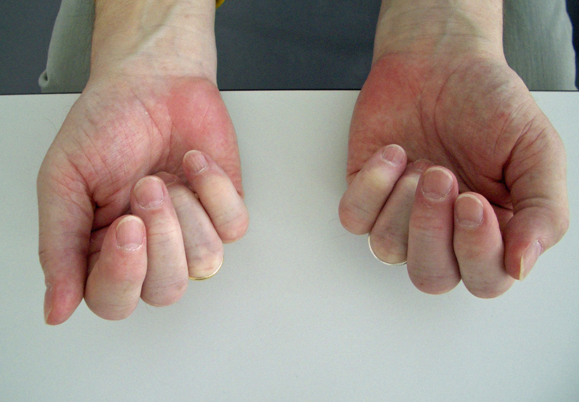 Fist in a patient with rheumatoid arthritis