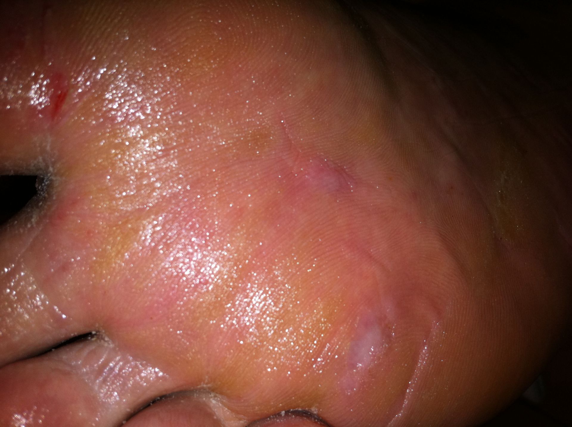 Plantar hyperkeratosis