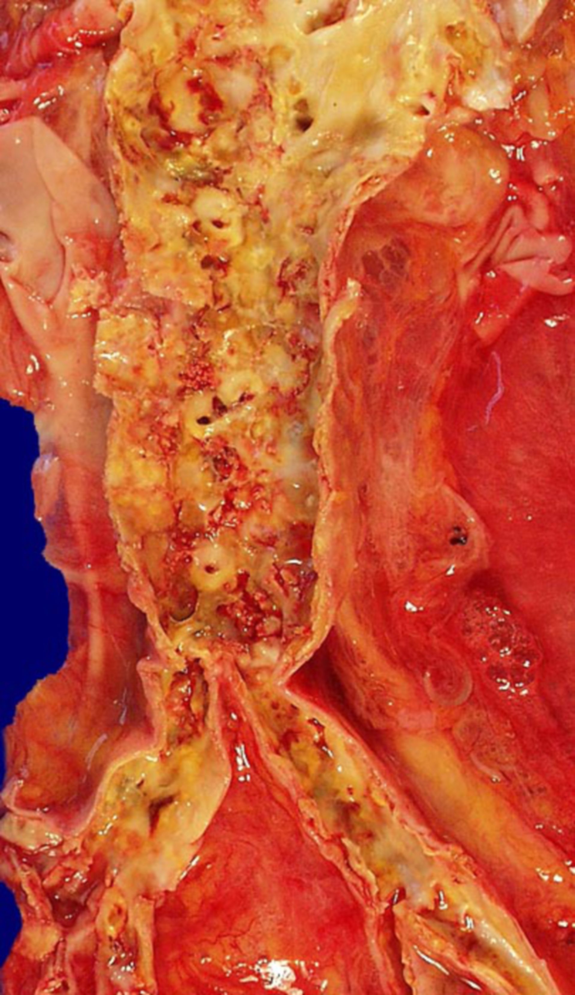 Abdominal aorta, moderate atherosclerosis
