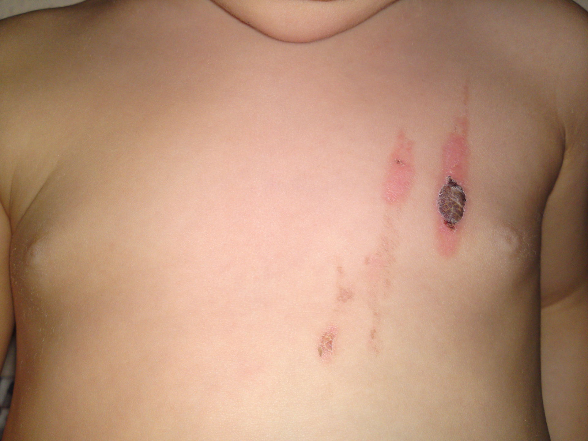 Child after scalding