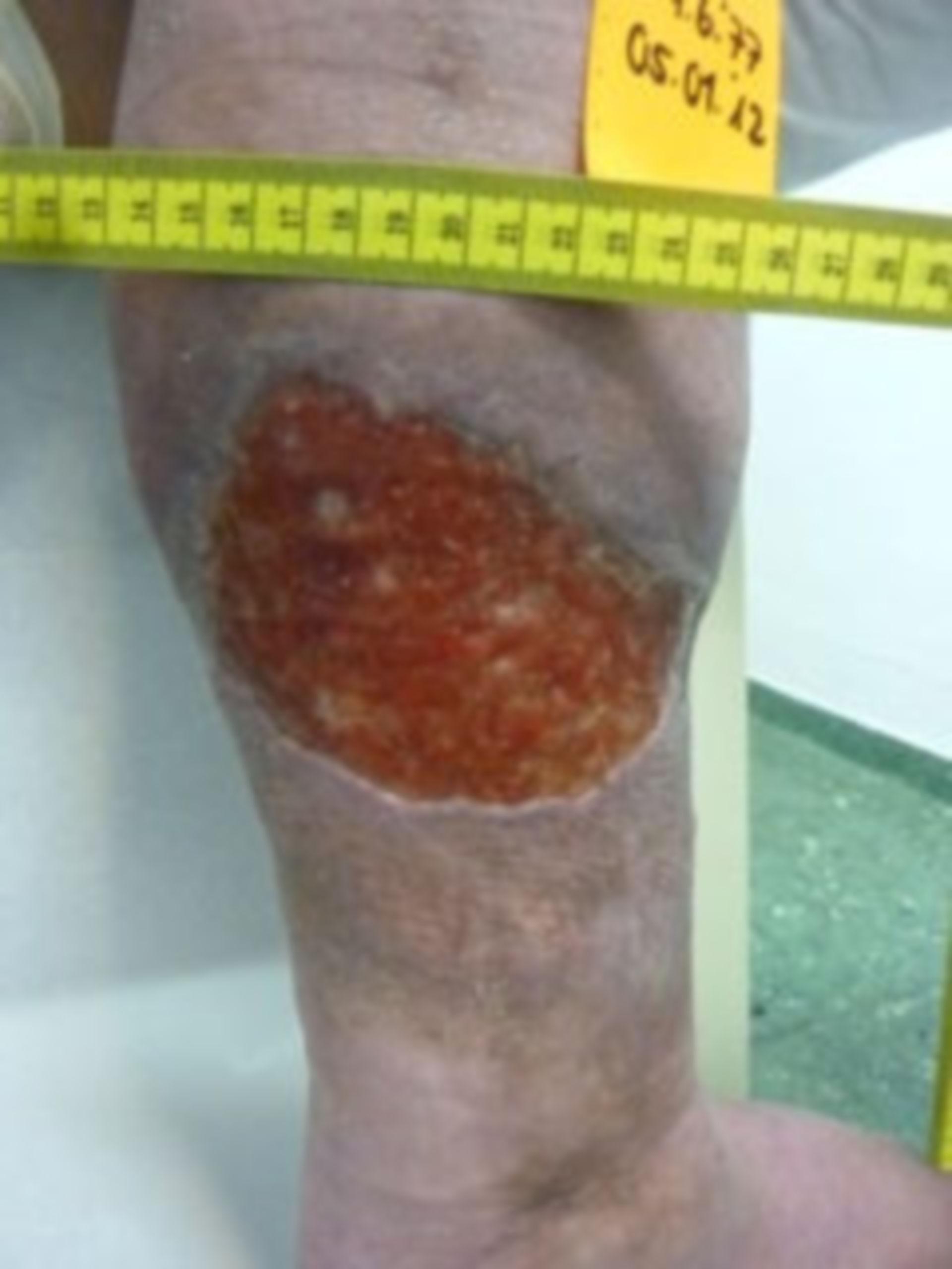 7 years open (24) - 01/05/12 healing process