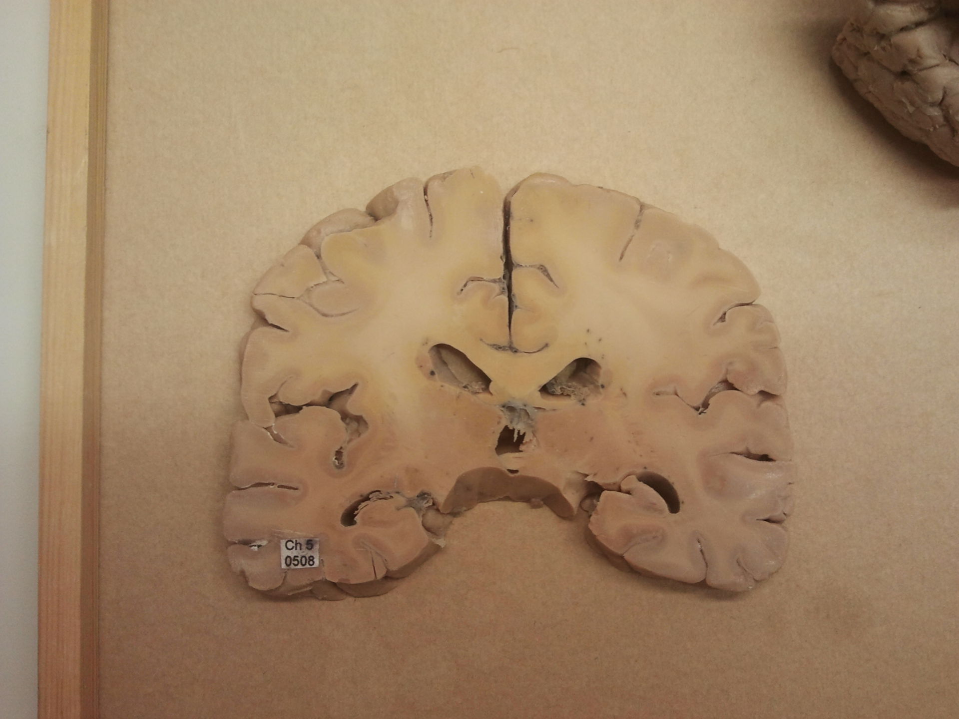 Sezione del cervello