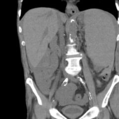 Thrombozytopenie - DocCheck Flexikon