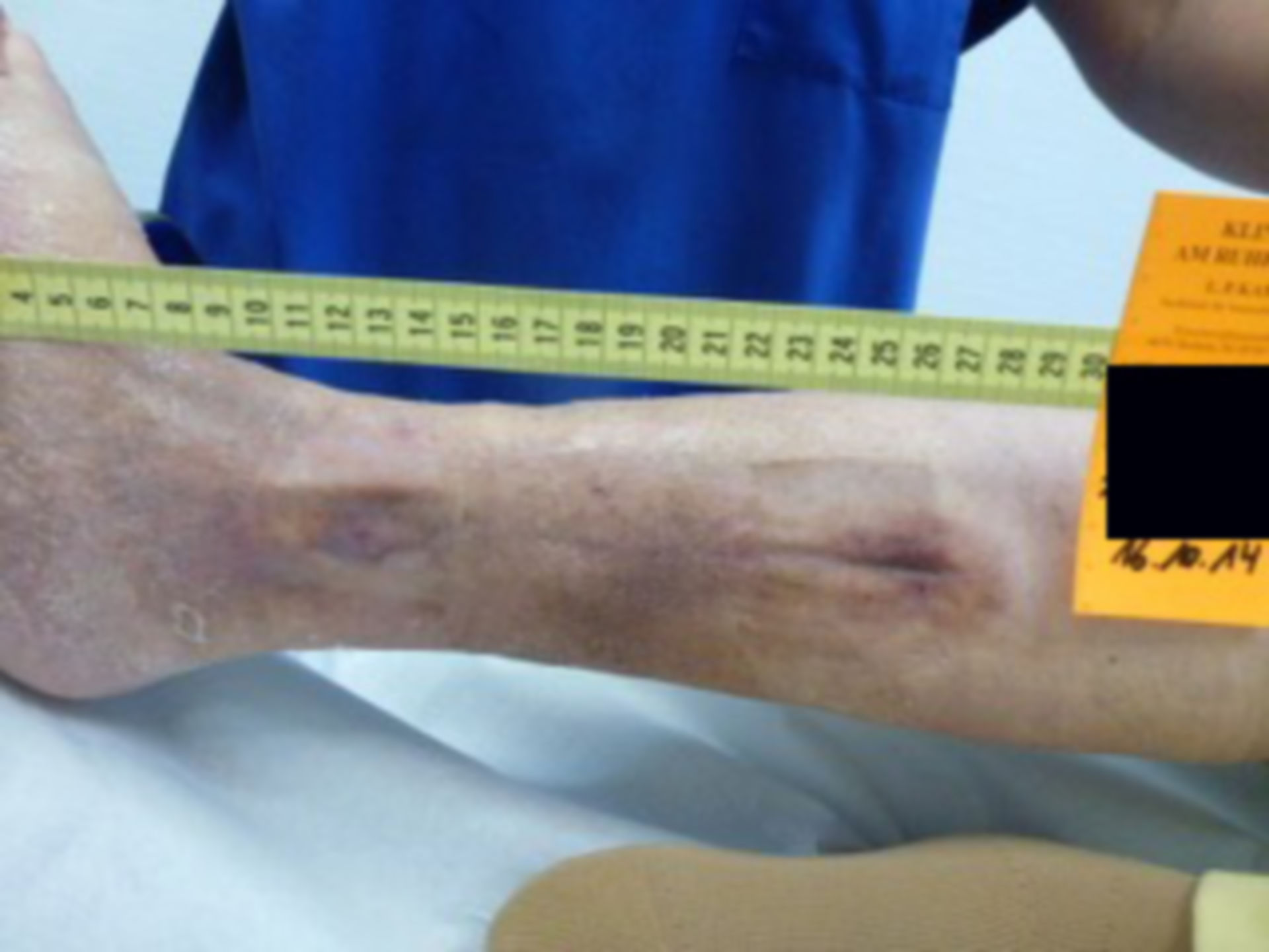 Ulcer of the lower leg - open for 18 months (10)