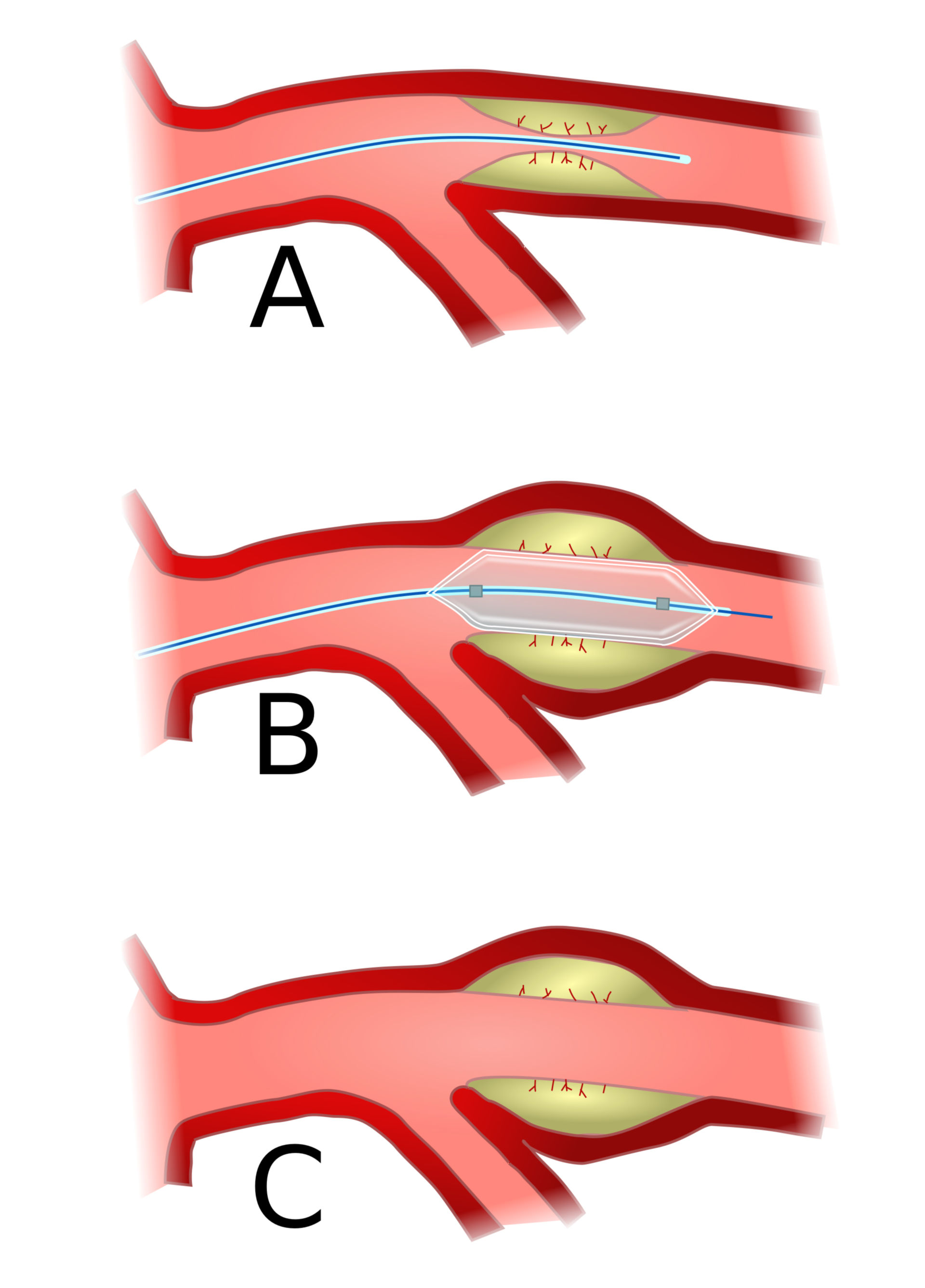 Koronarangioplastie (PTCA)