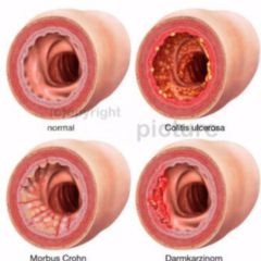 Hämatochezie DocCheck Flexikon