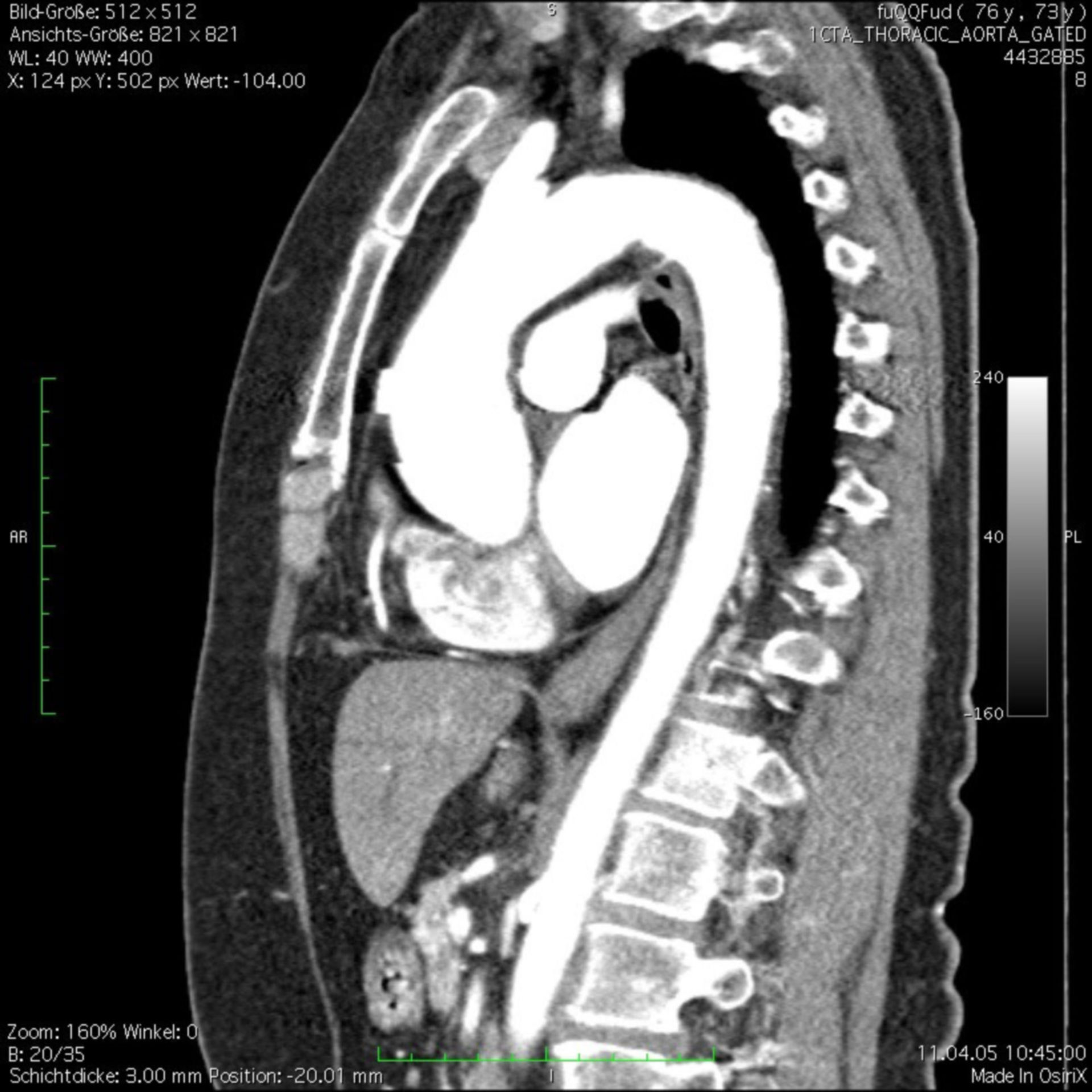 CT thorax, with contrast media
