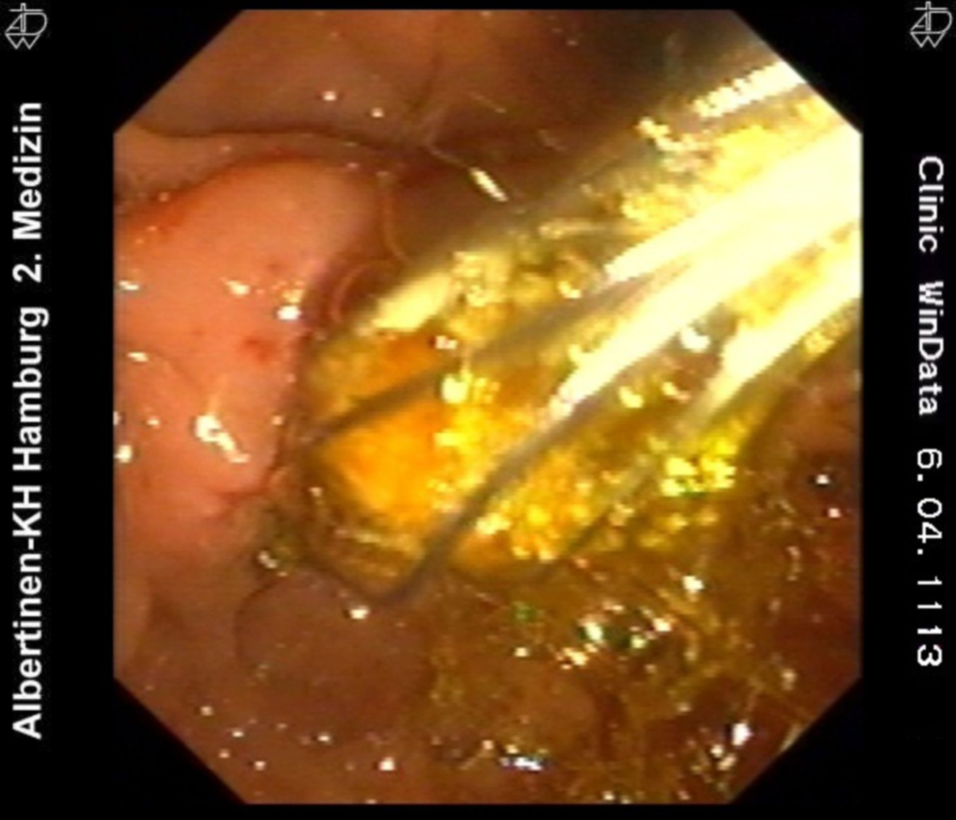 Removal of a cholesterol stone