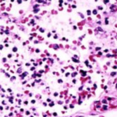Langhans-Riesenzelle - DocCheck Flexikon