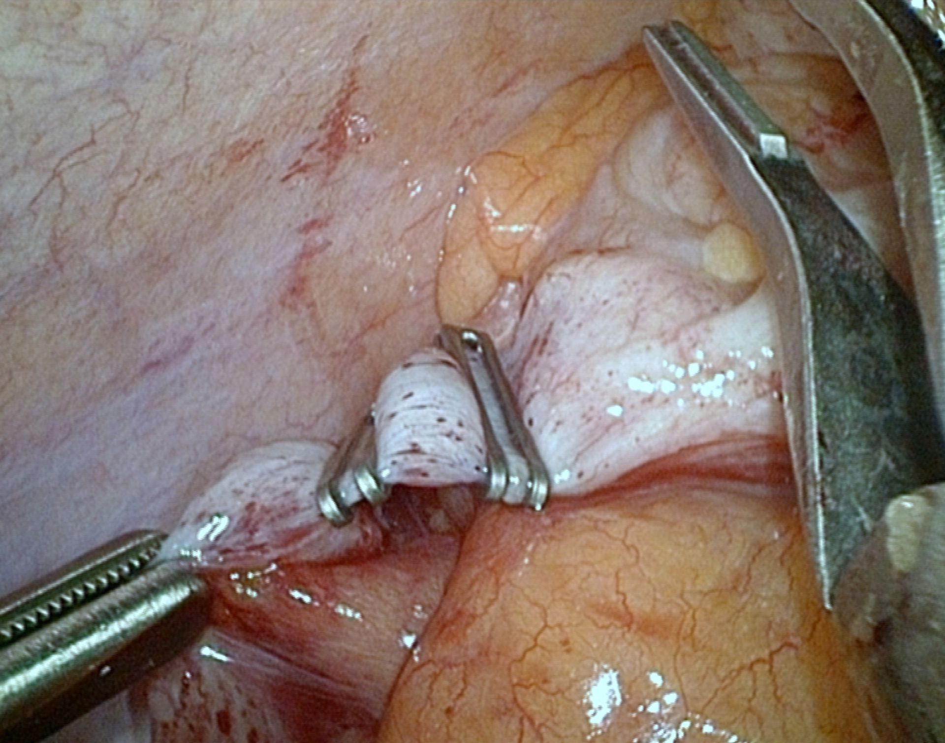 Appendicectomia laparoscopica