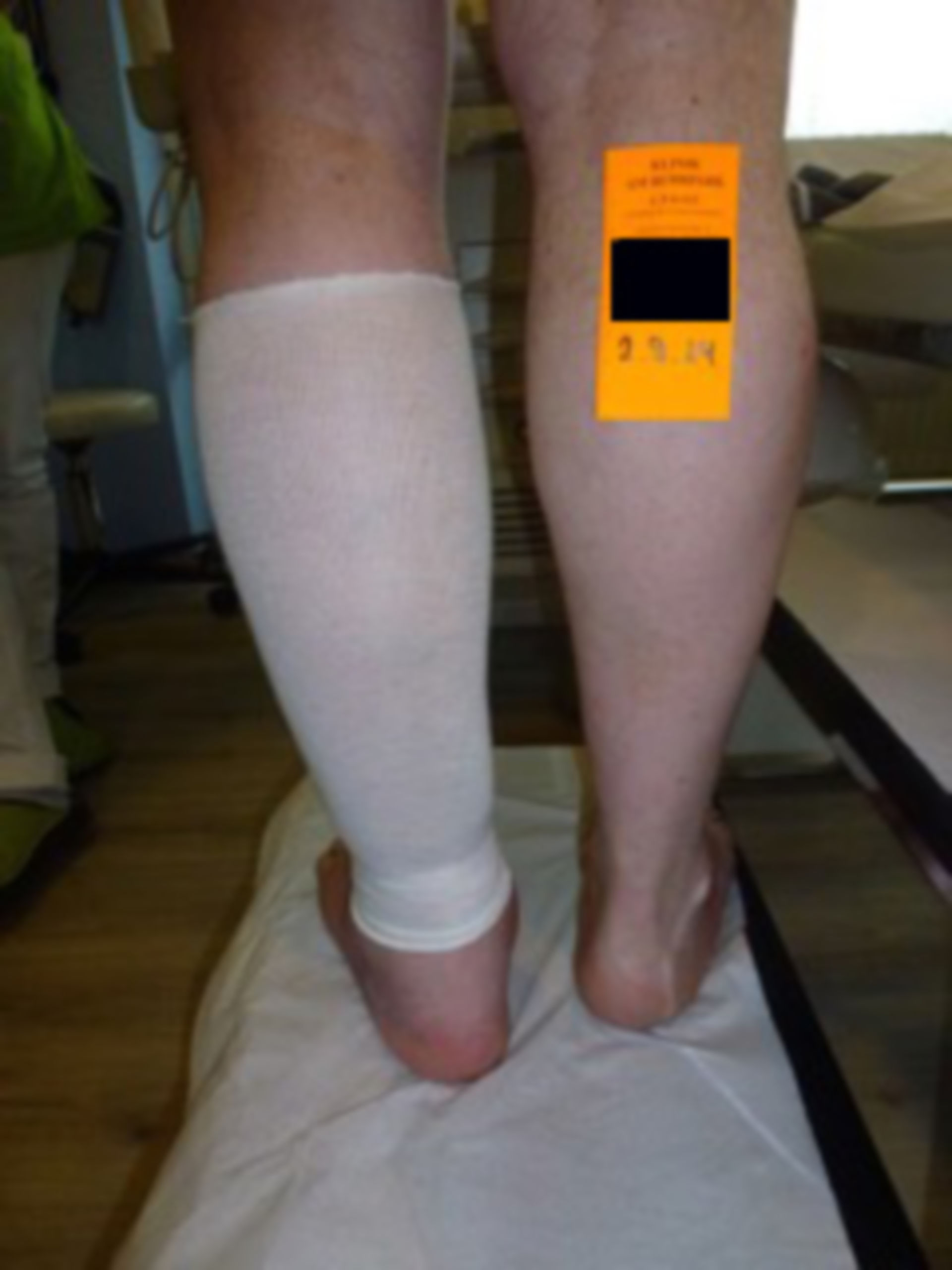 Ulcer of the lower leg - 20 open for 20 years: modern wound care (3)