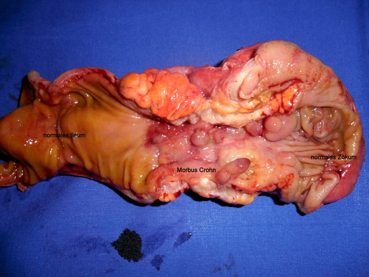 Morbus Crohn-Ileozökalresektion