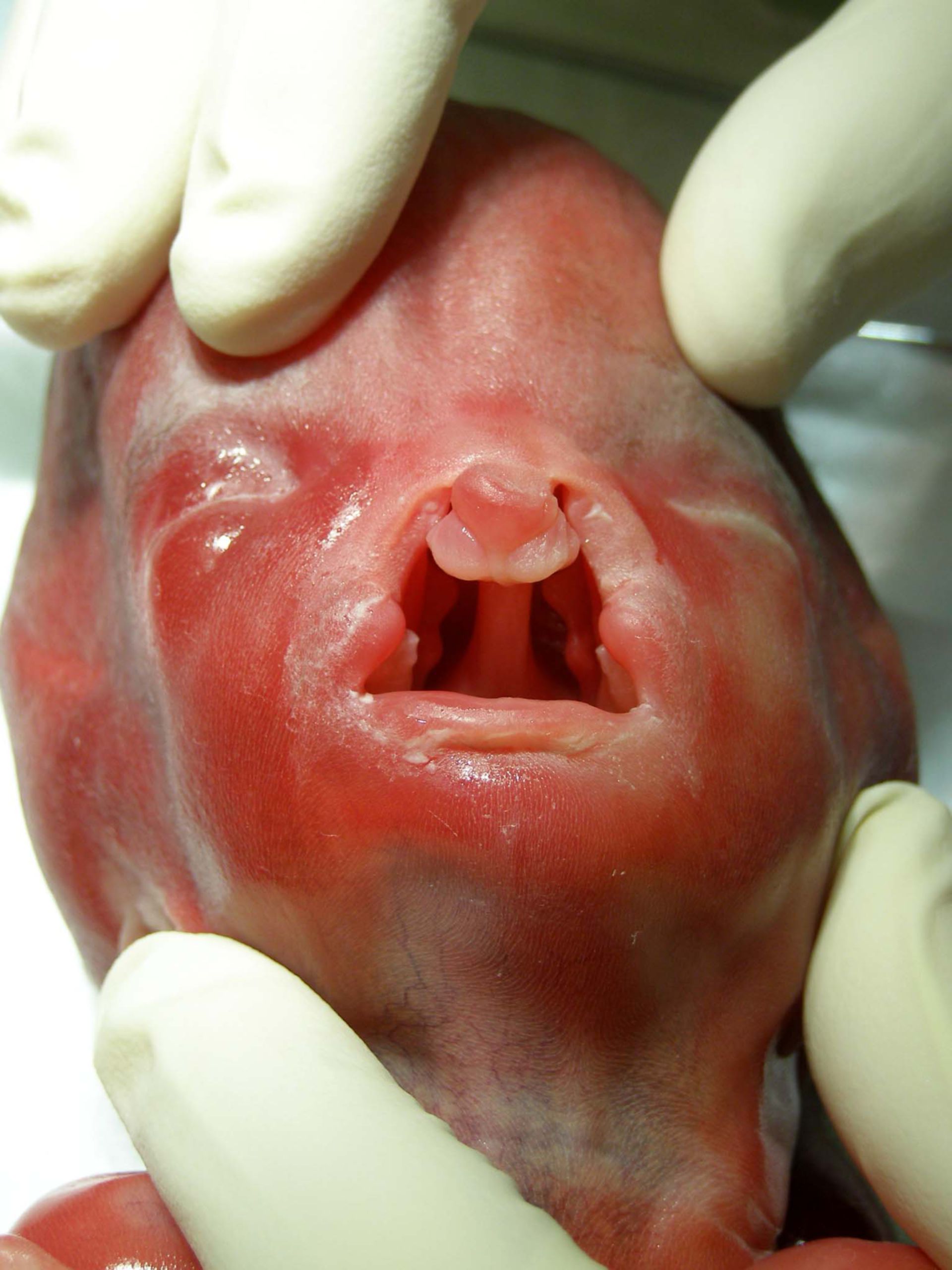 Fetal deformity