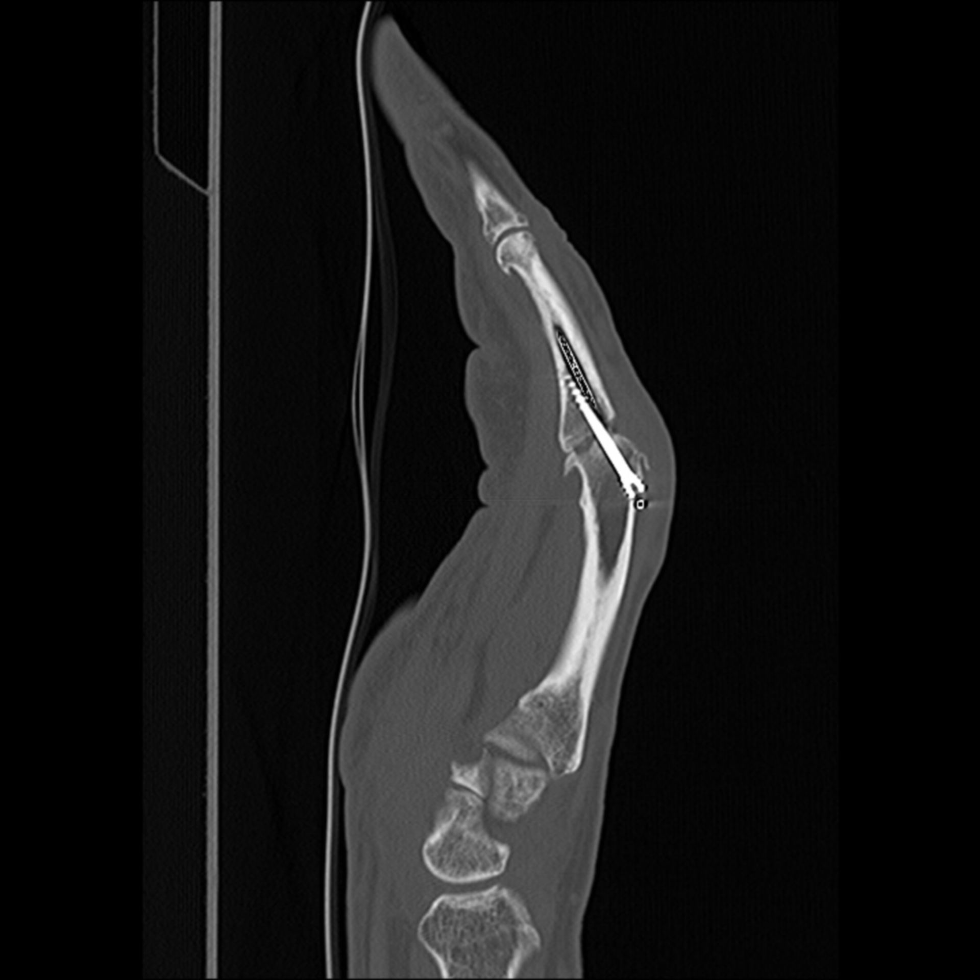 Metacarpo falangeo fissato attraverso Herbert vite - CT