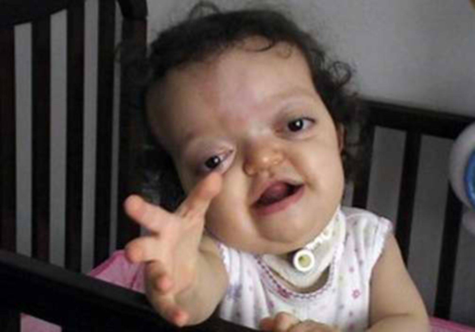 Pfeiffer Syndrome