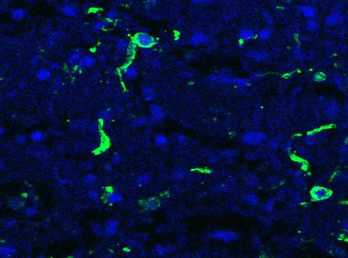 Sterbende Tumorzellen - Blau eingefärbt sind die Zellkerne, Grün durch Strahlung erreichte DNA-Schäd ... © Ingo Bechmann / Felicitas Merz 