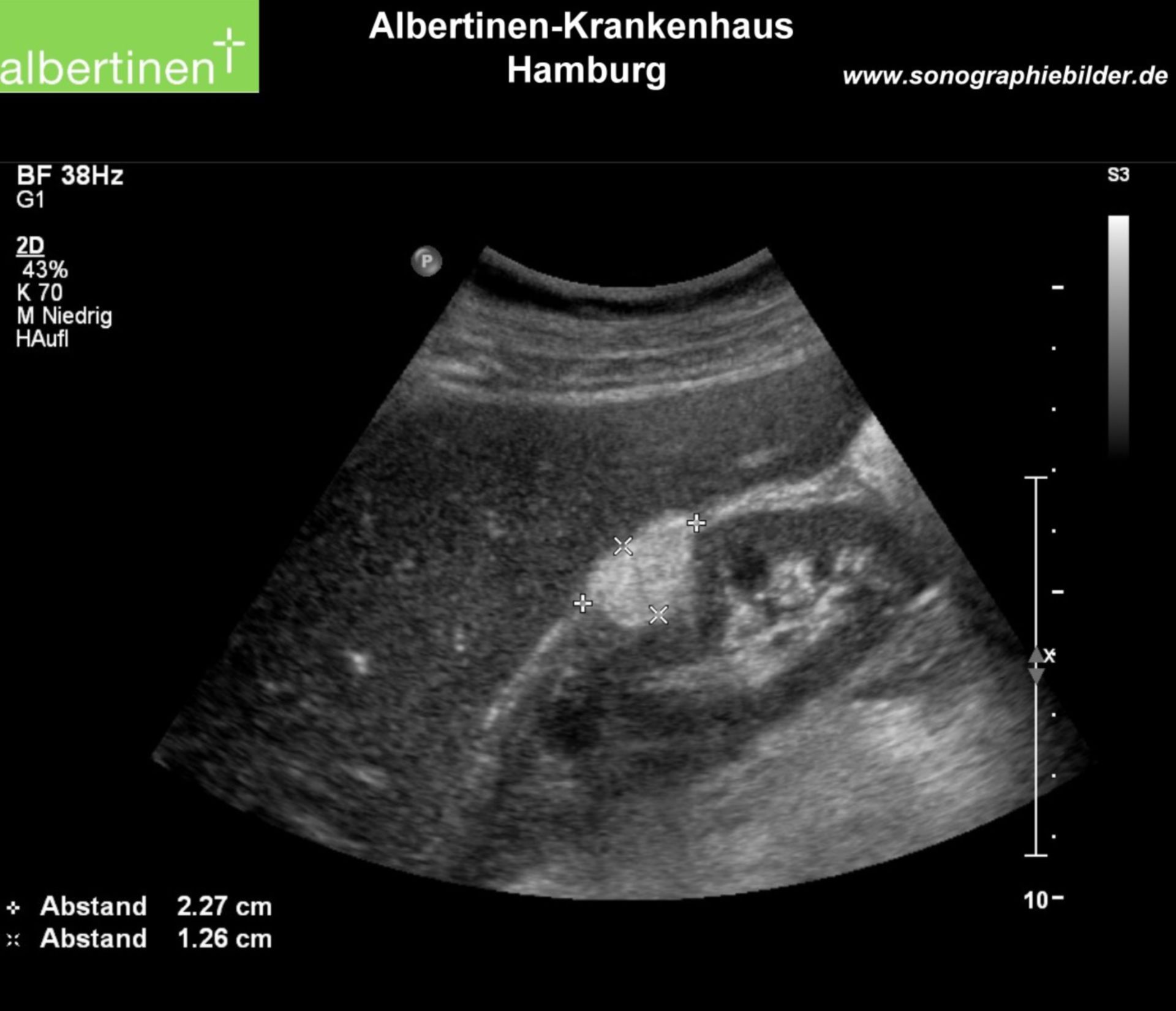 Angiomyolipoma