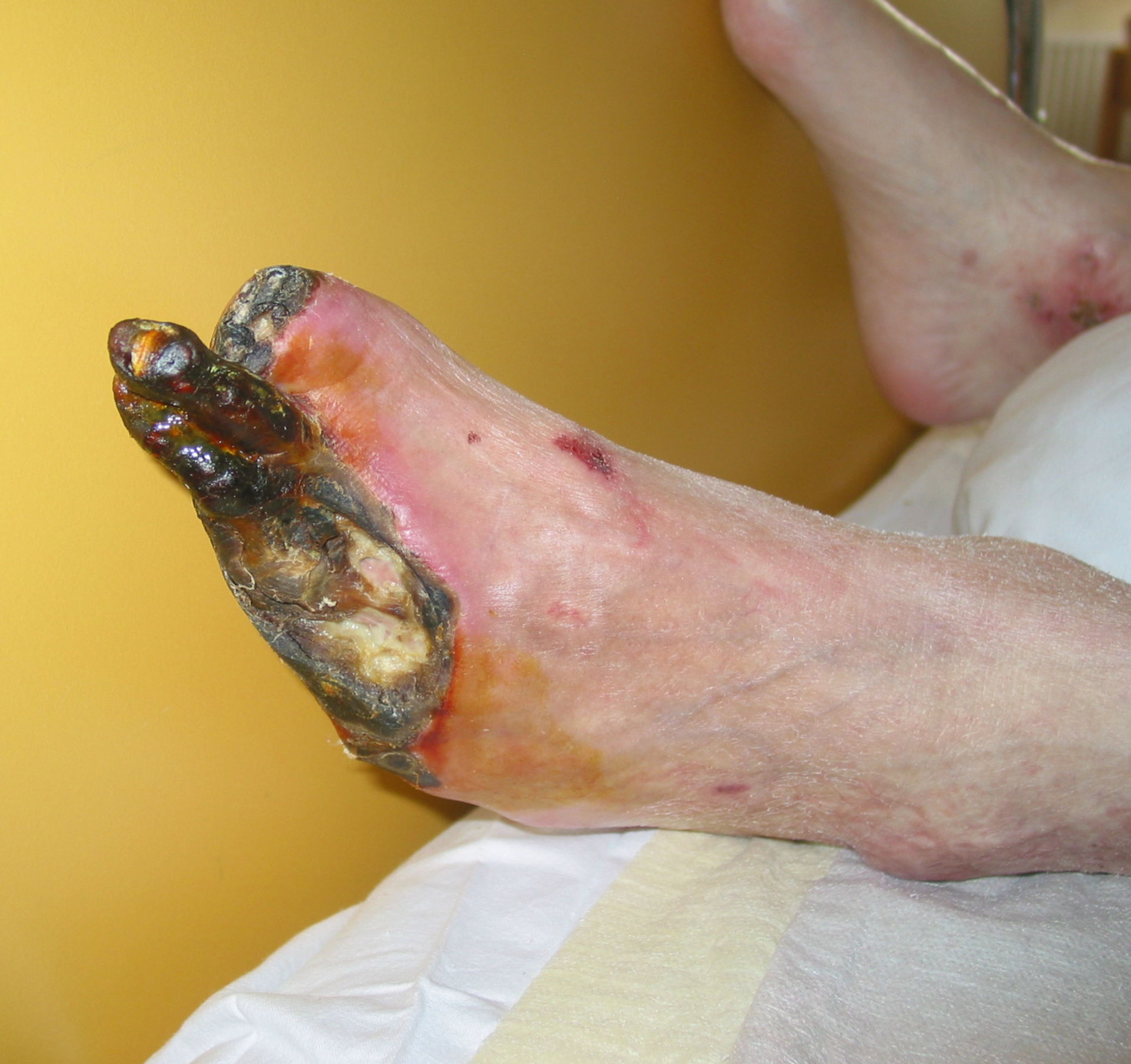 Forefoot gangrene by peripheral artery disease (PAD) Fontaine IV / Rutherford 6