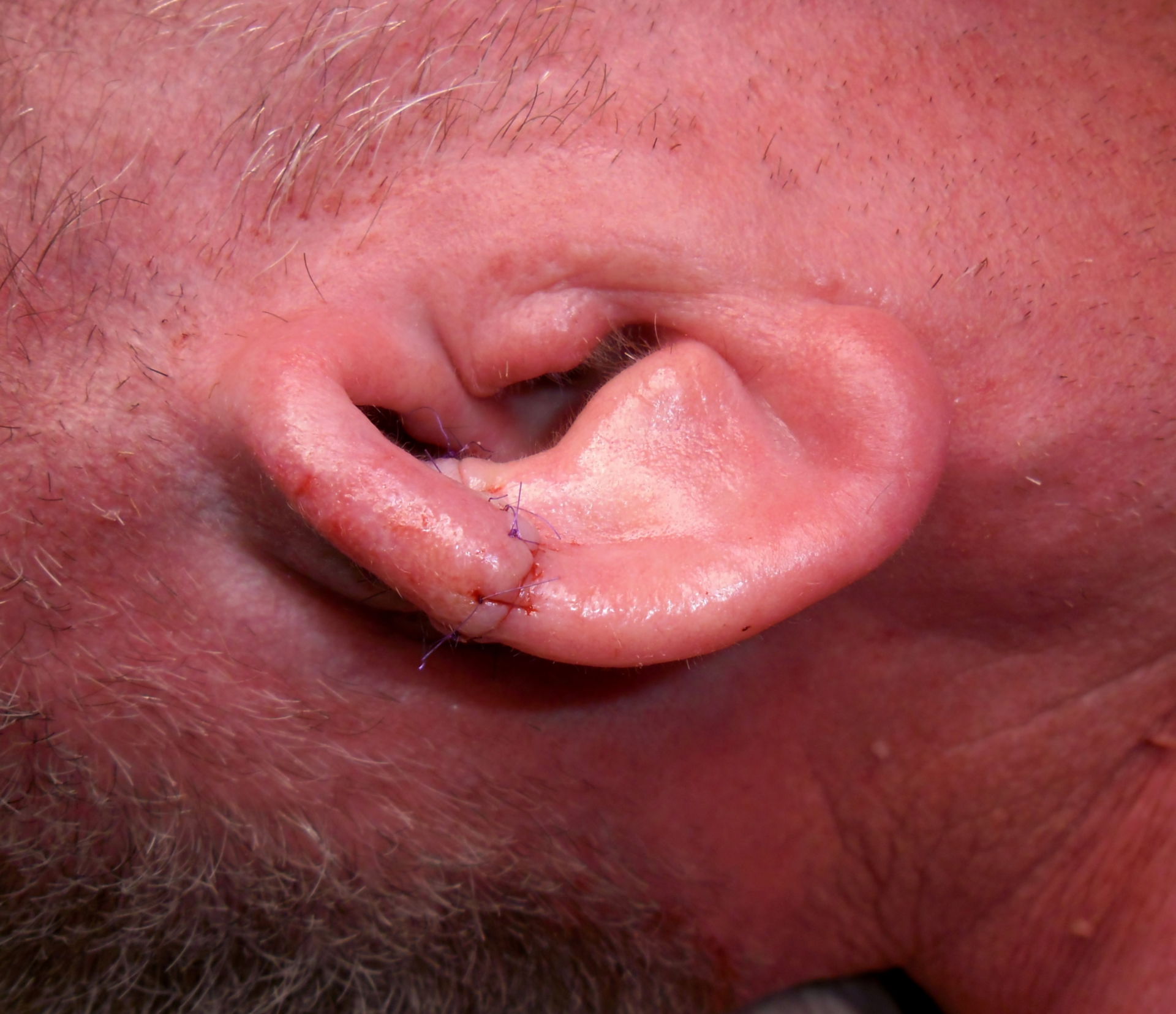 Risultato postoperatorio dopo una resezione parziale della cartilagine auricolare