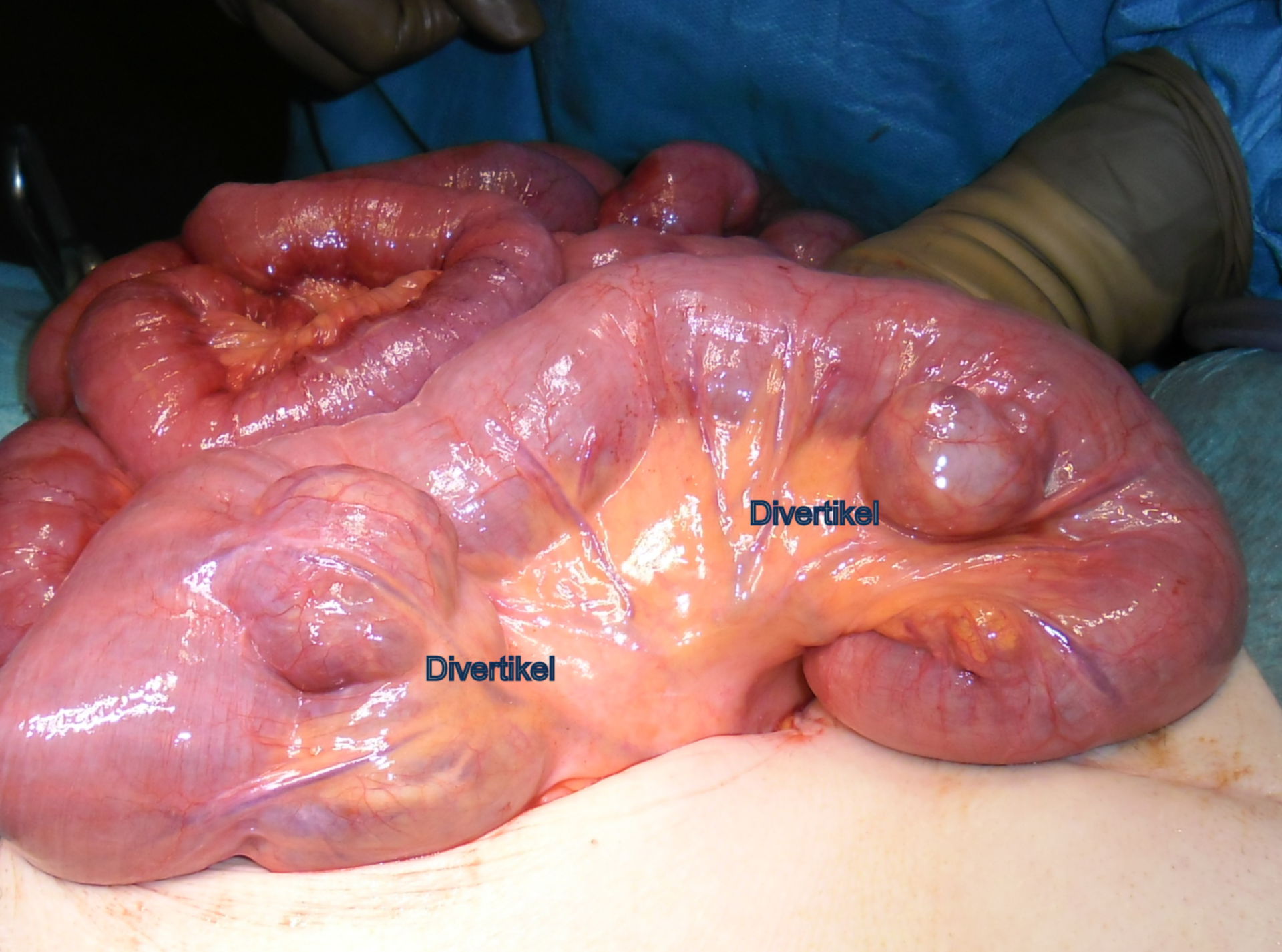Small intestine diverticula 2