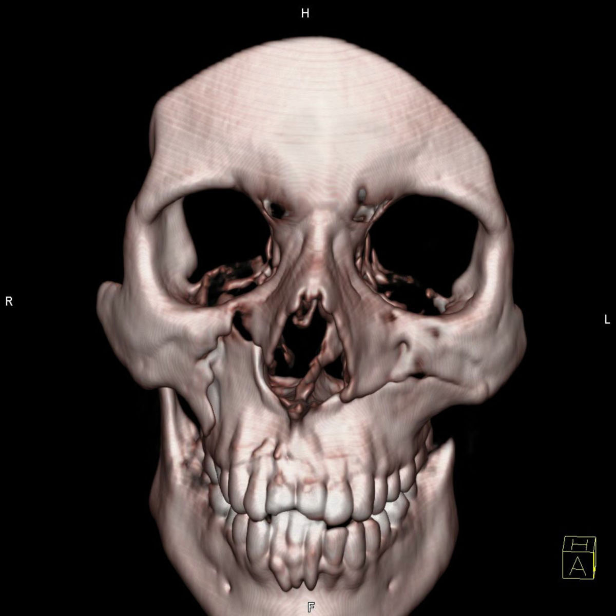 Mandibula - DocCheck Flexikon