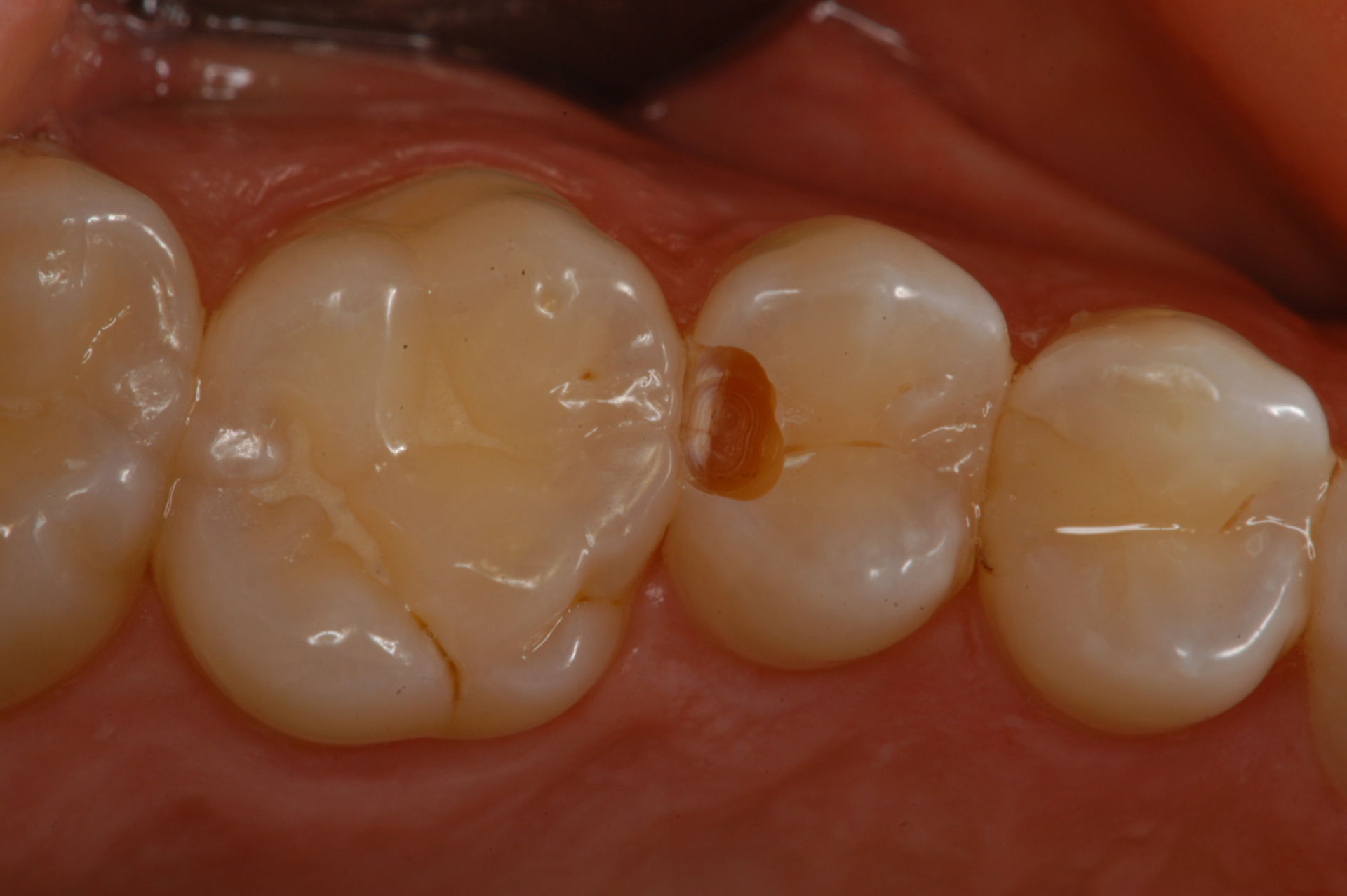 Karies zwischen zwischen Zahn 25 und  26
