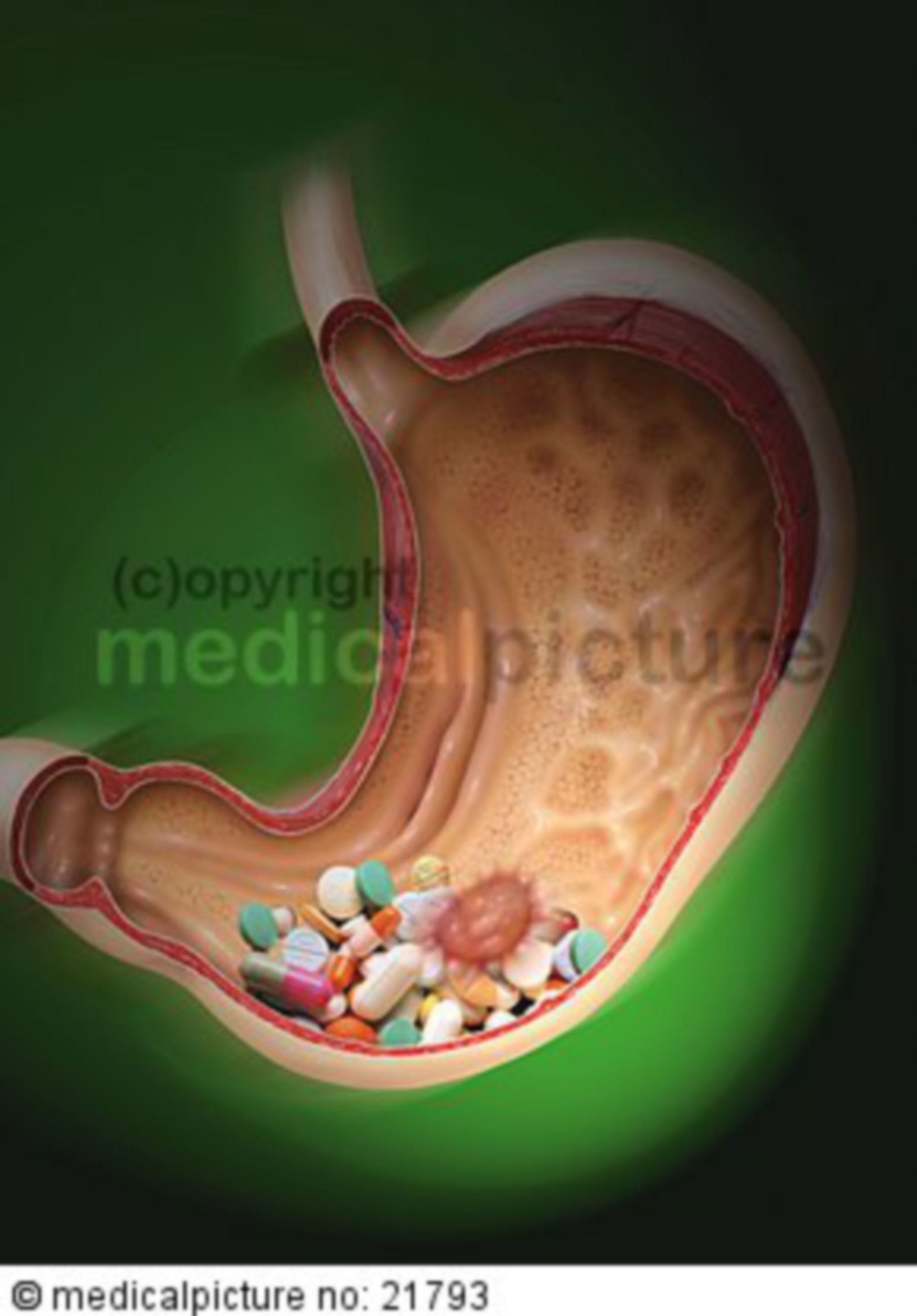 Gastric ulcer with medicaments